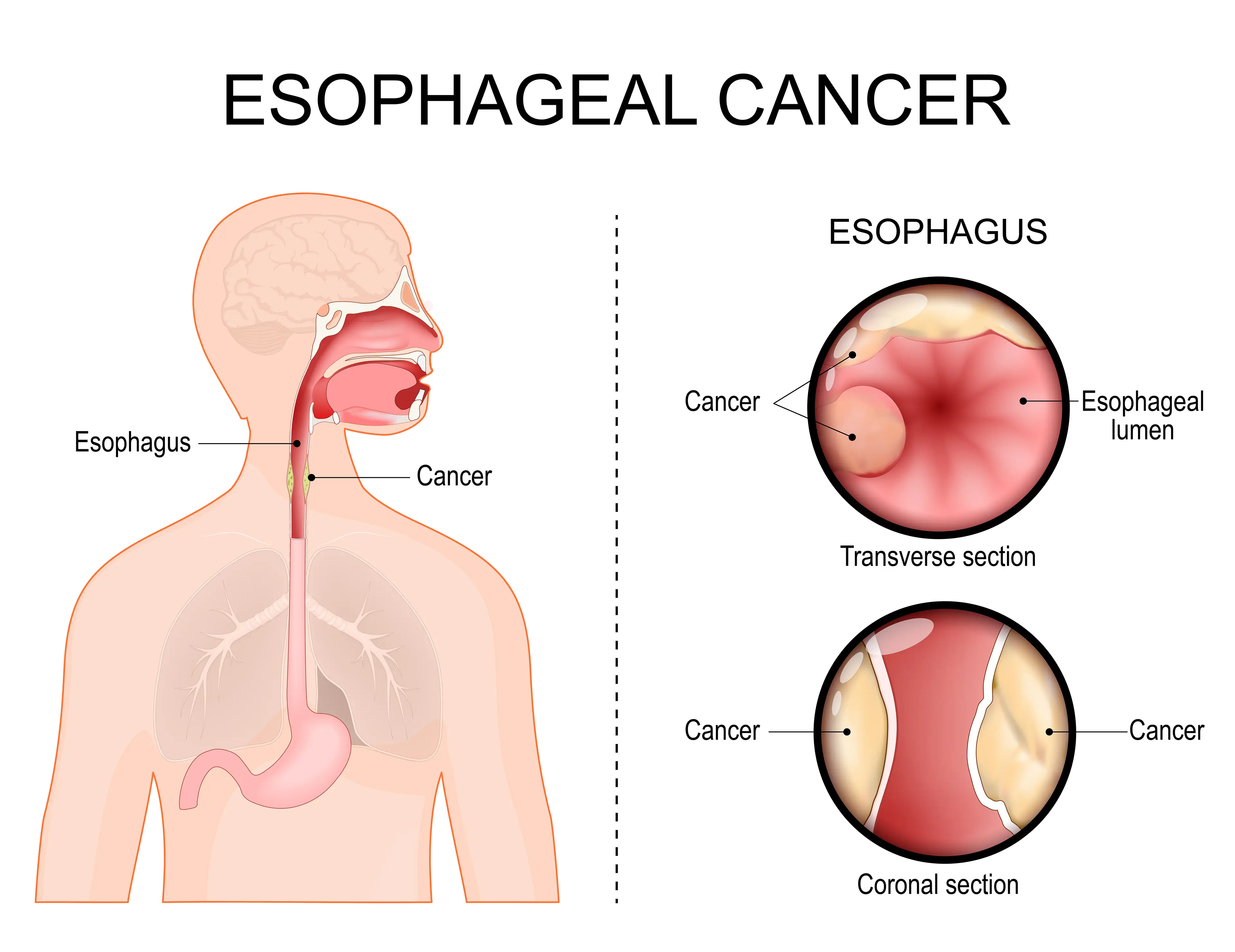 The cancer is often discovered late (Getty Stock Photo)