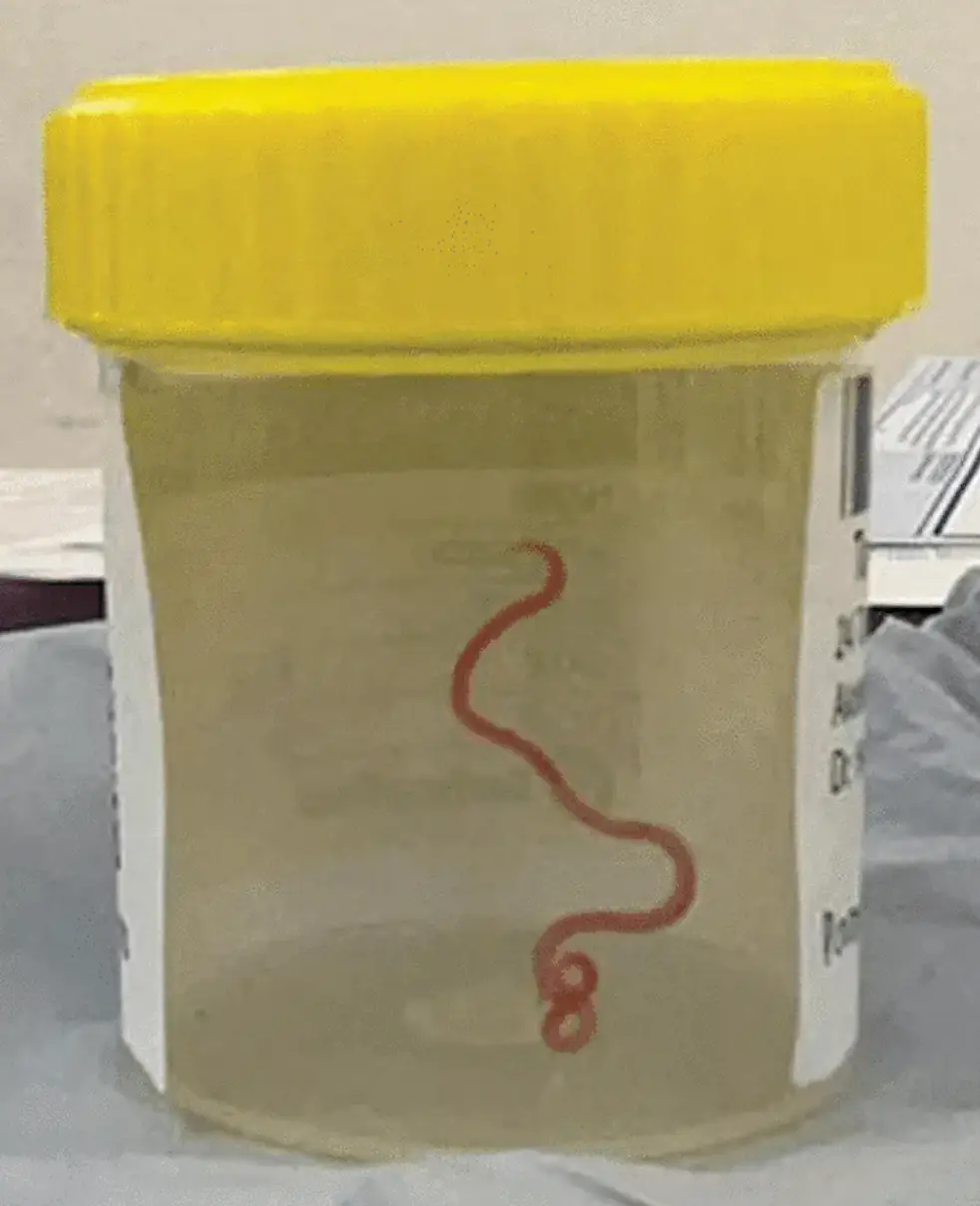 The parasite was successfully removed last year.