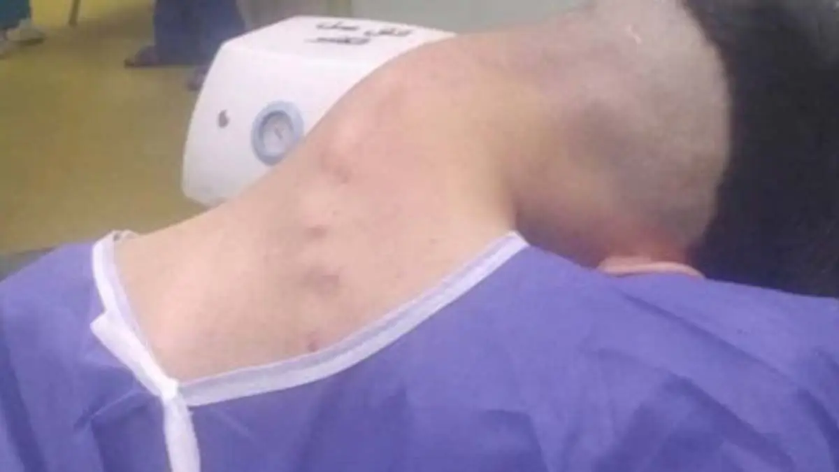 The man developed the rare condition after a history of substance abuse (Department of Neurosurgery, Isfahan University of Medical Sciences)