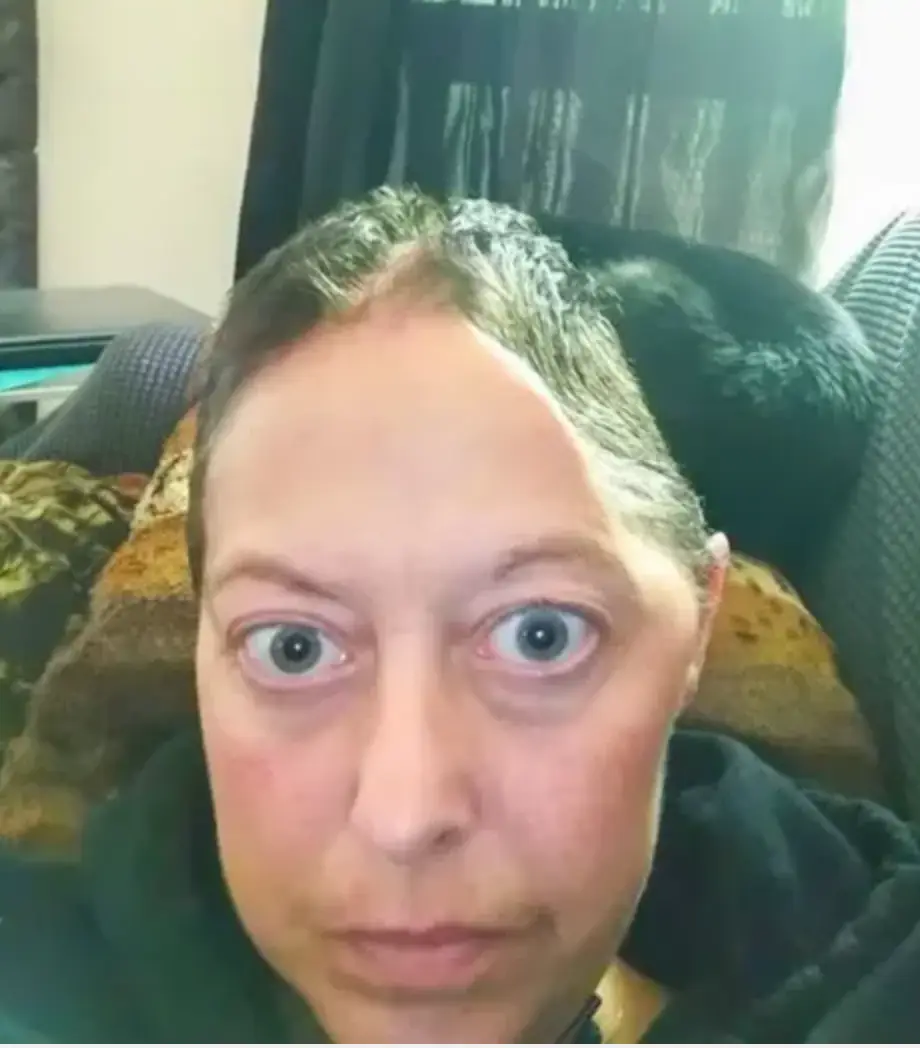 Ms McClure had to have part of her skull removed.