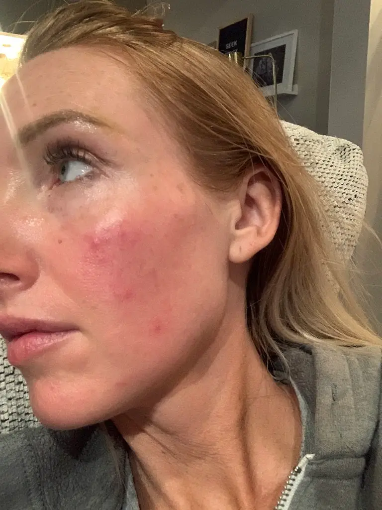 The mom now has ongoing issues with her skin (SWNS)