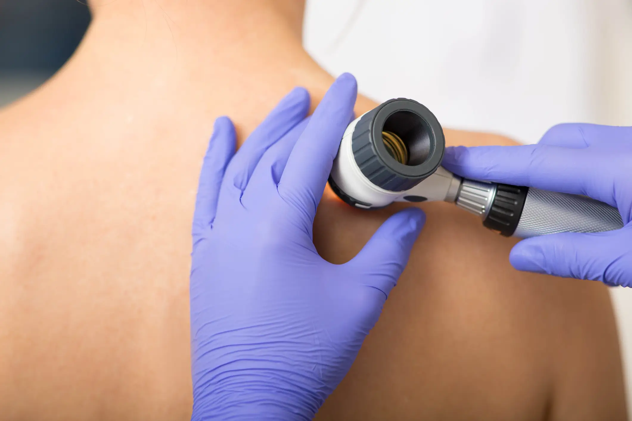 Most skin cancer is treatable if it’s caught early (Getty Stock Images)