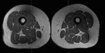 An MRI scan of a 61-year-old woman's thigh - her diet was 30 percent UPFs (Radiology)
