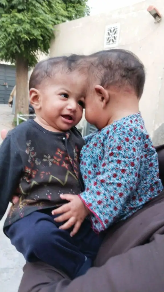 Craniopagus twins are extremely rare (Turkish Health Ministry/Anadolu via Getty Images)