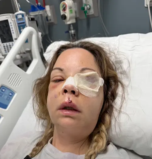 Lindsey says she's been left with '12 fractures' in her face (KTVT/ CBS Texas)