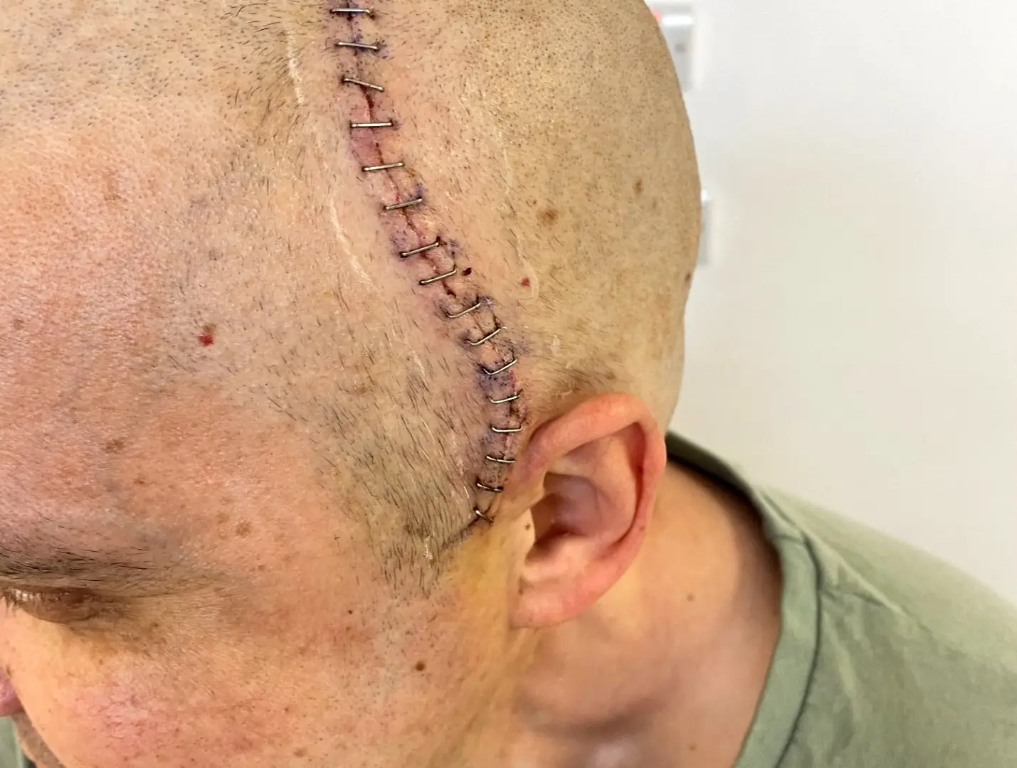Stu has had a craniotomy to remove the brain tumor (Cover Images)