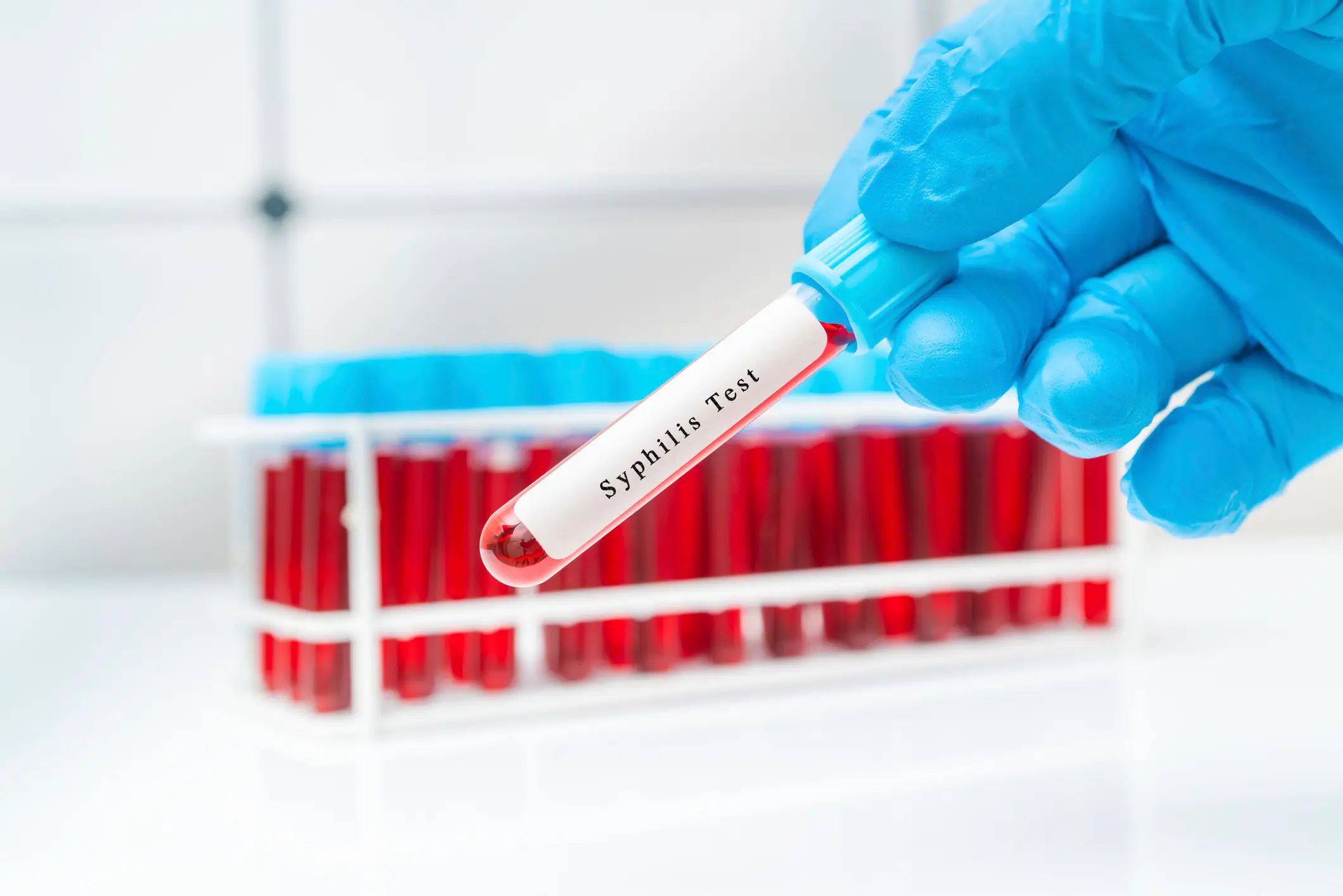 Cases of syphilis are reportedly on the rise (Getty Stock Photo)