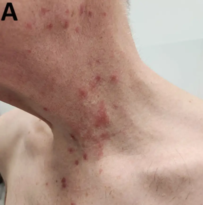 The infection has been reported in nine men in Barcelona (CDC)