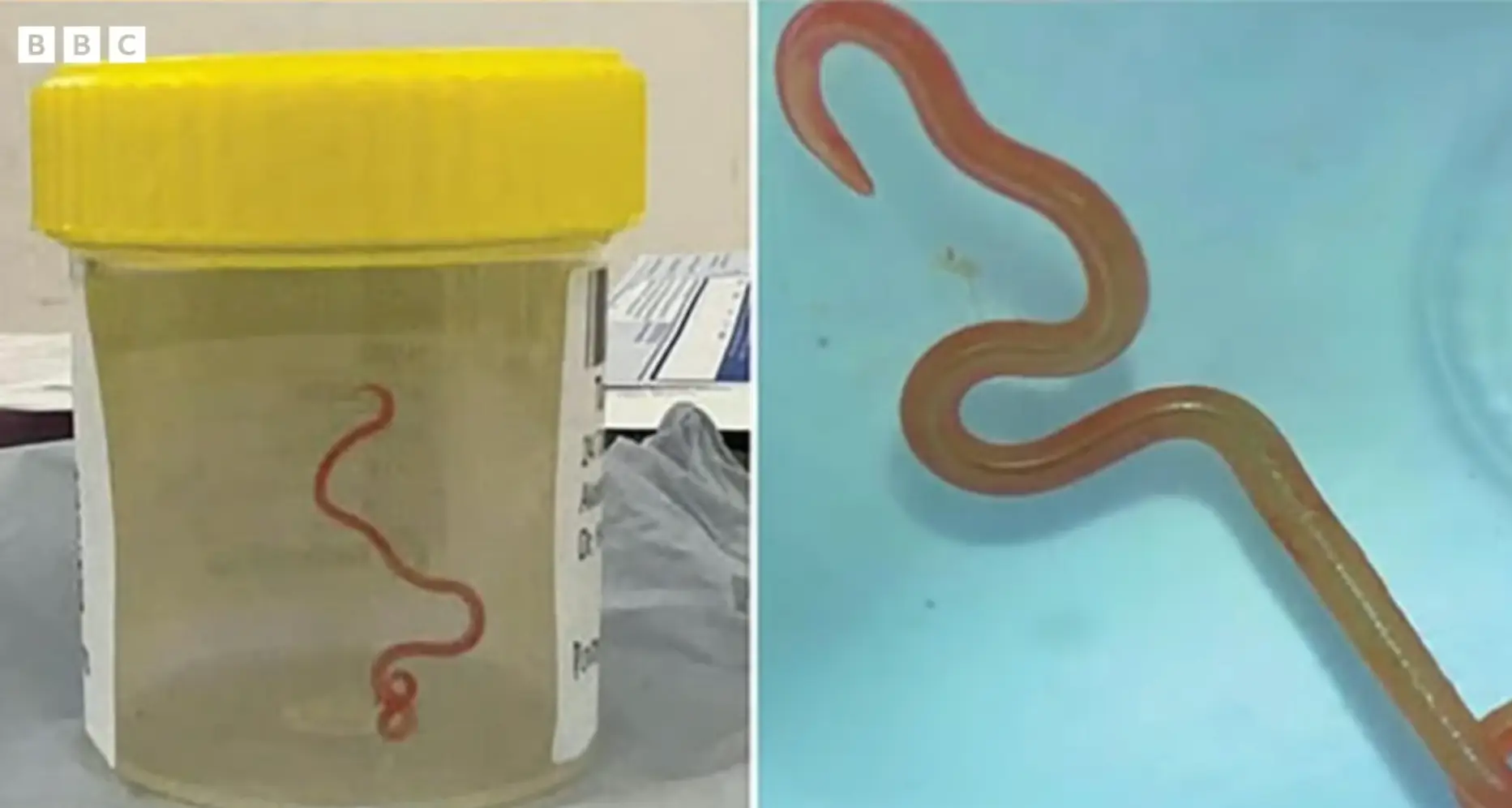 The shocking ordeal marked a world first (BBC News)