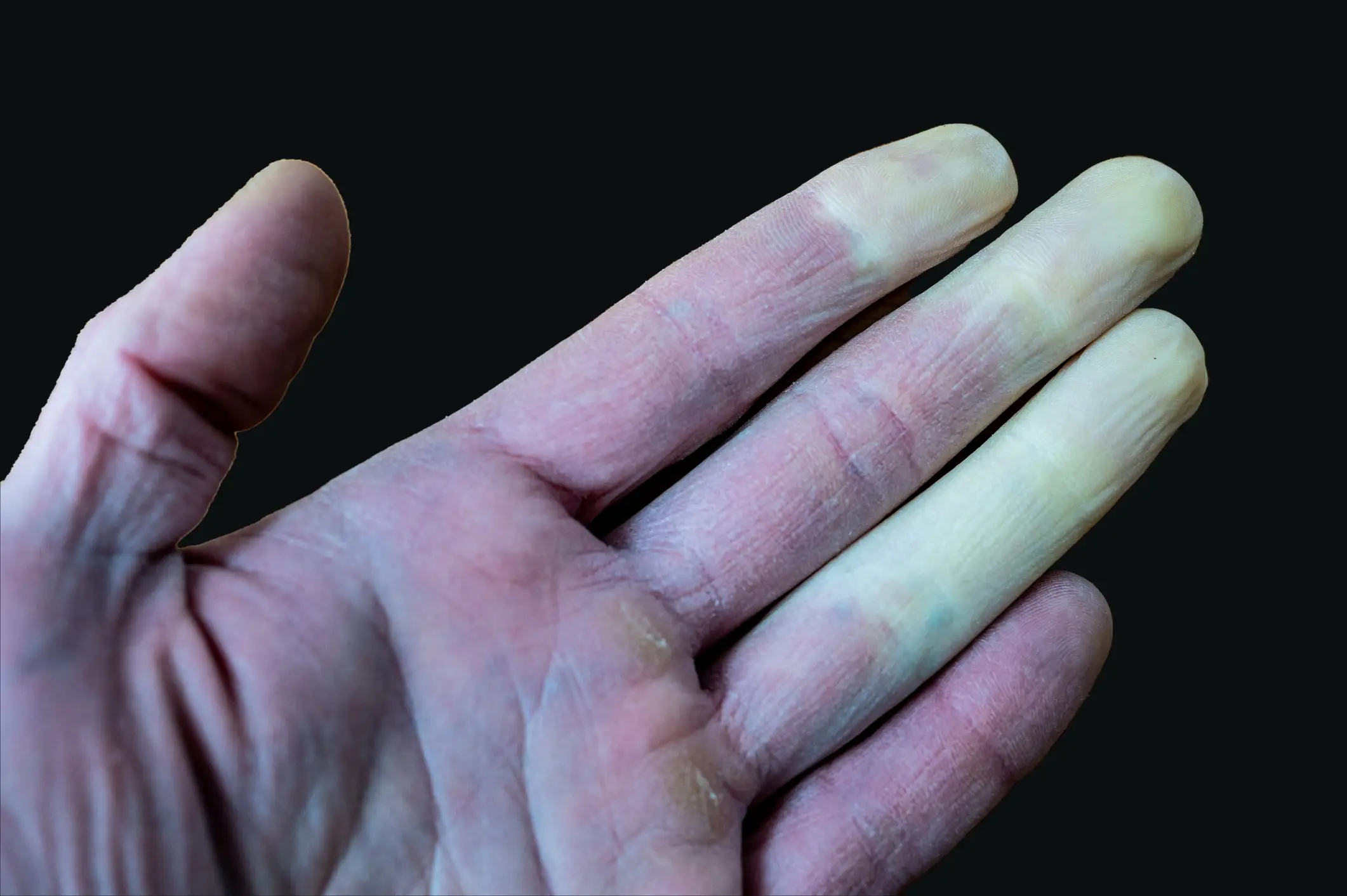 Raynaud's disease can cause your fingers to change color (Getty Stock Photo)