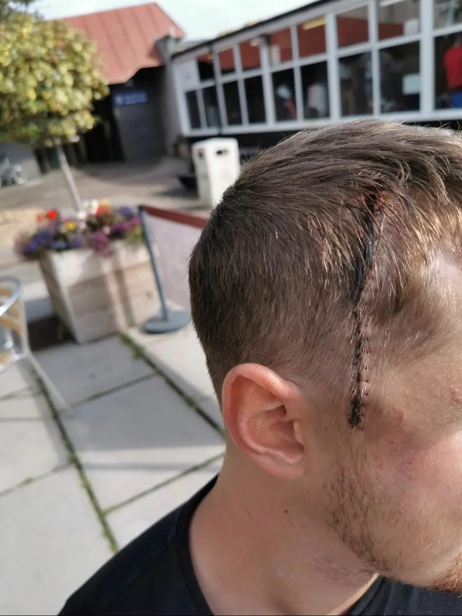 Hinch has had multiple rounds of treatment as his cancer came back(SWNS)