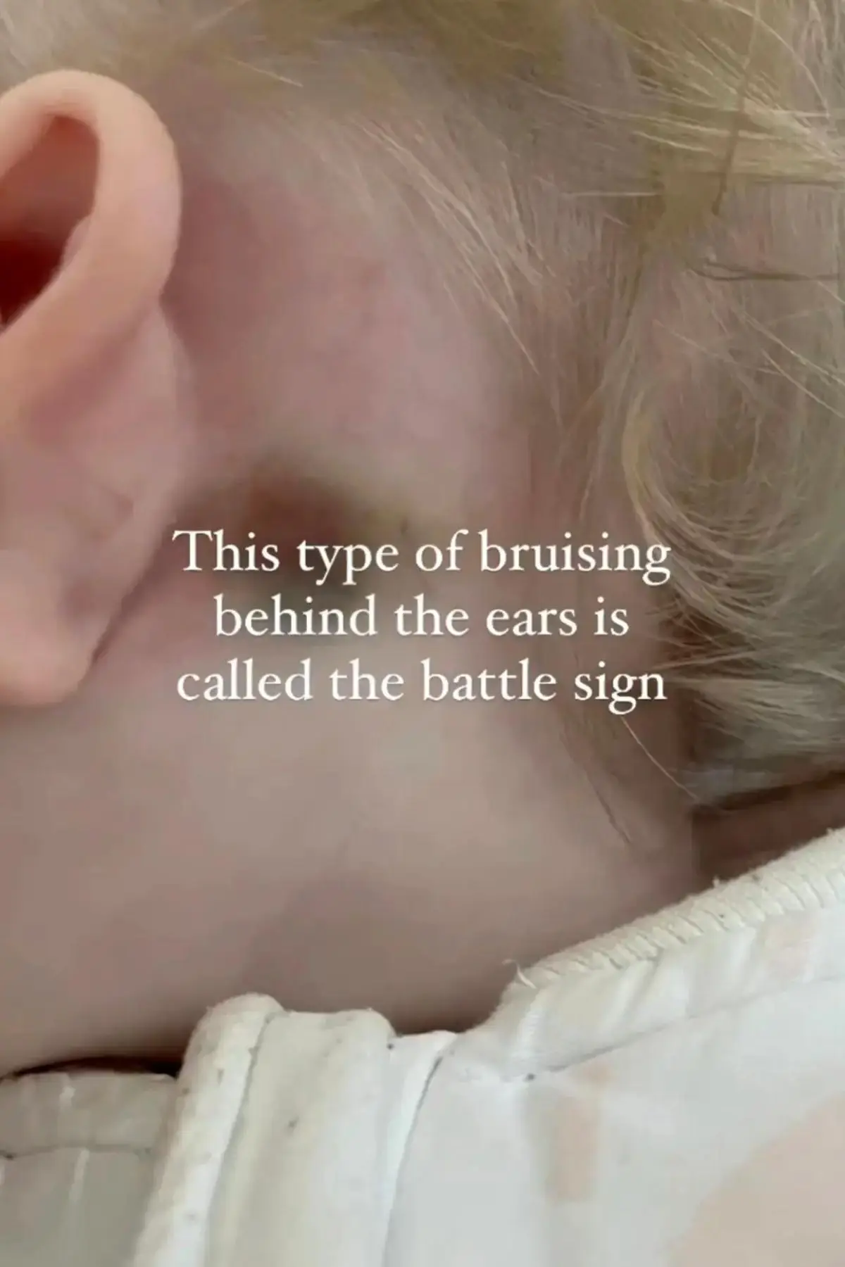 Battle signs could indicate a basilar skull fracture. (Instagram/@tinyheartseducation)