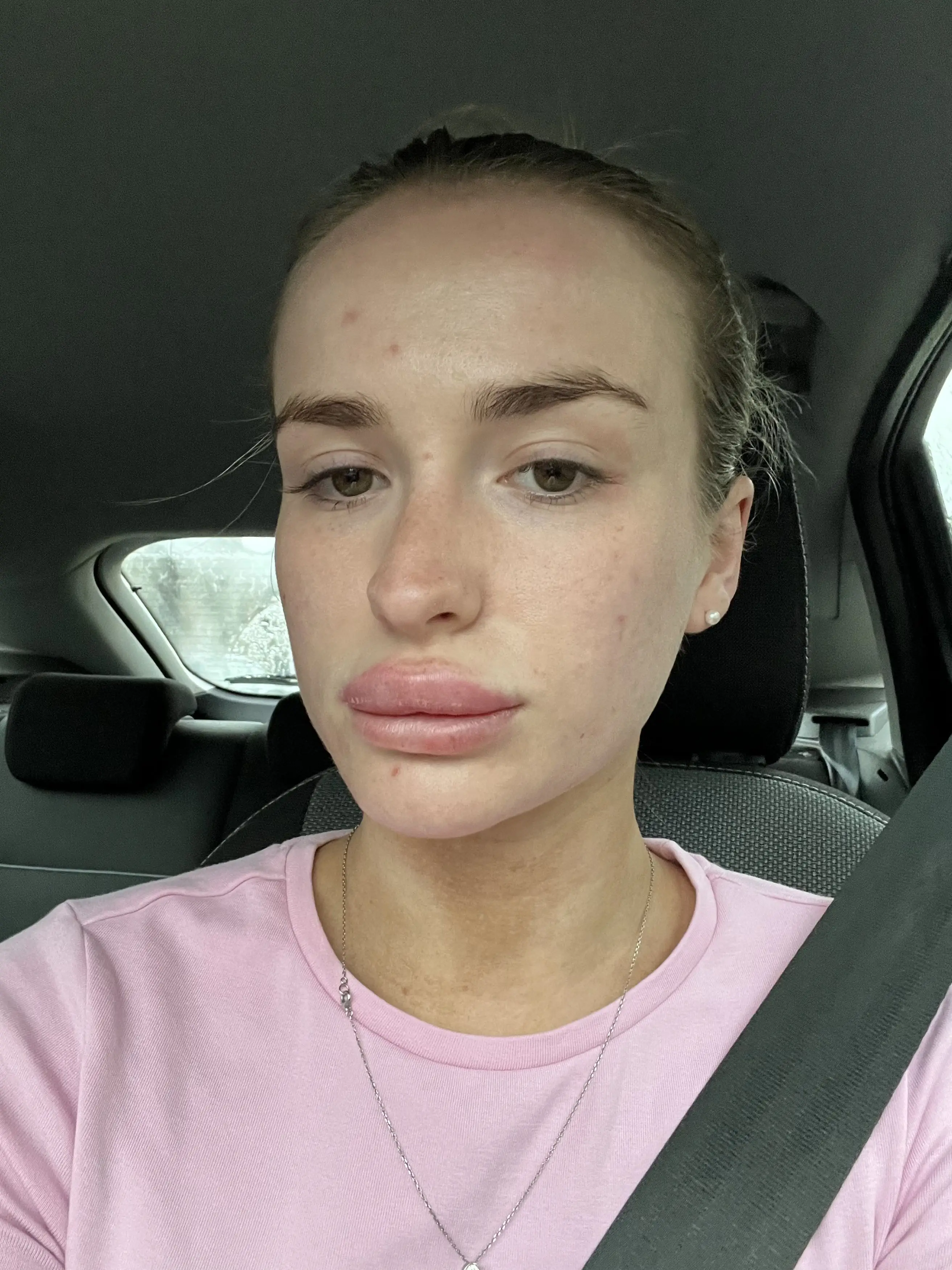 Lily Thompstone woke up with swollen lips (Kennedy News and Media)