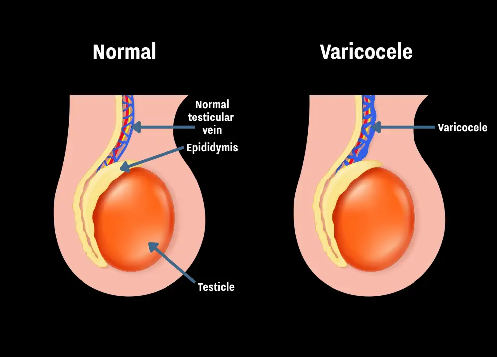 The difference between a normal testicle and one with varicocele (Getty Stock Images)