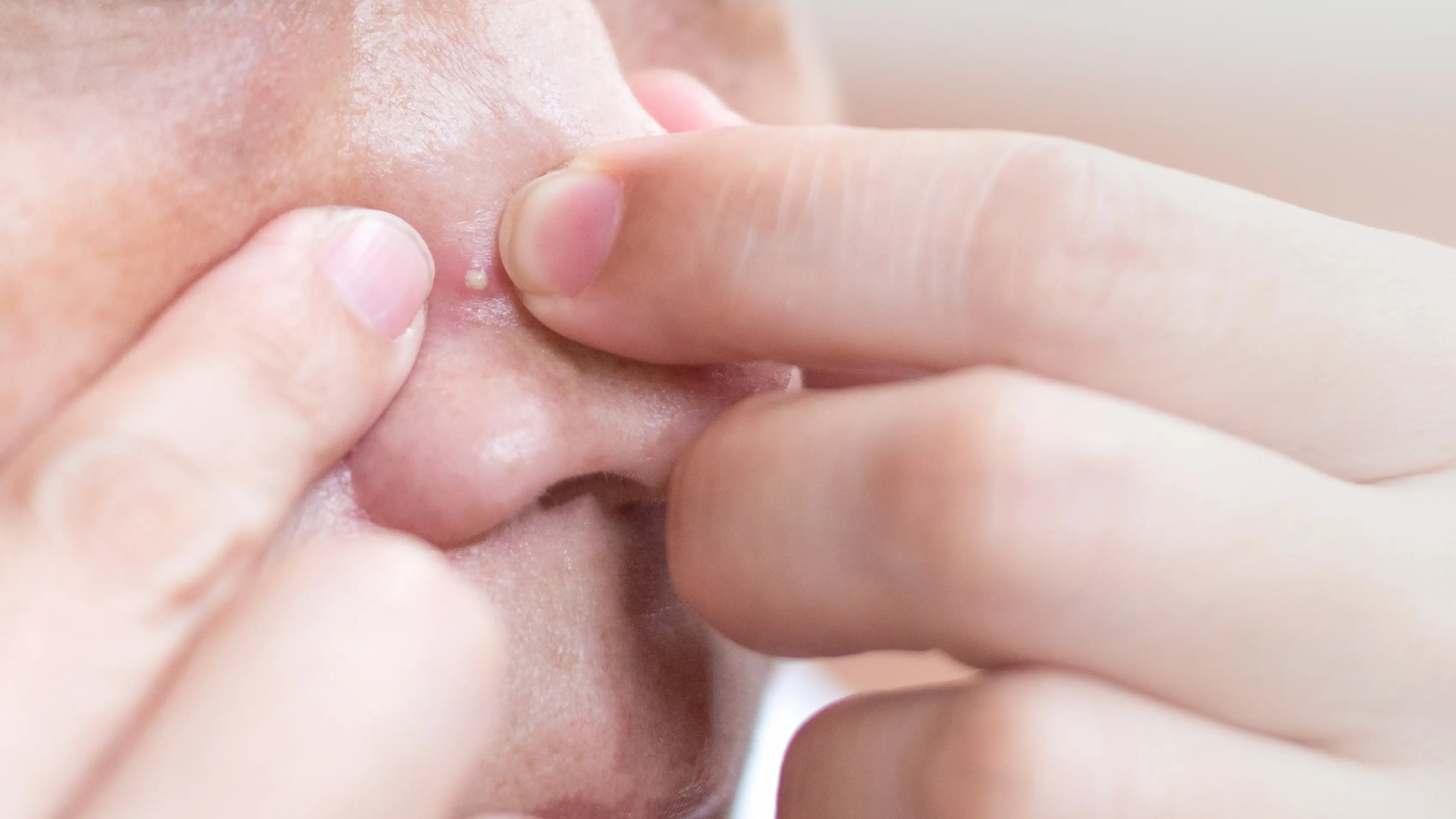 It's not a good idea to pop a spot in the triangle (Getty Stock Photo)