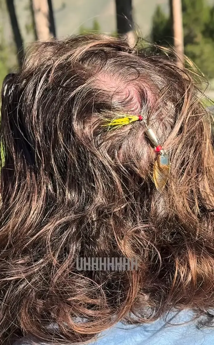 The video clip shared by the couple revealed the hook lodged firmly in Tyler's scalp (Tylerhubbard/instagram)