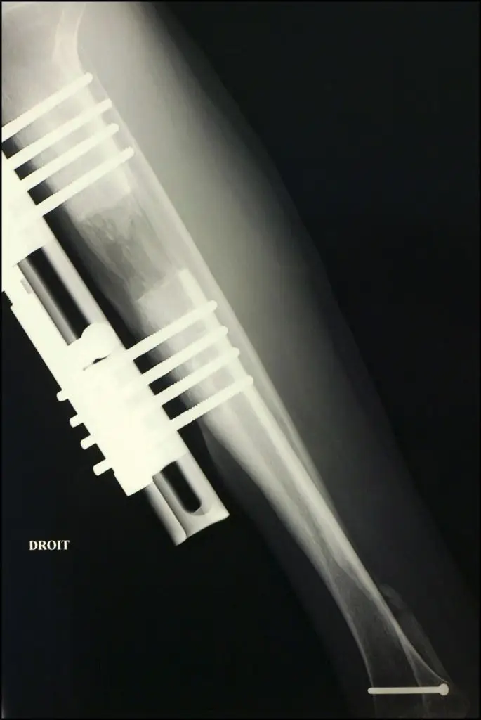 The leg-lenthening procedure can often be costly and comes with a long recovery and rehabilitation period (Photo by Jean-Francois DEROUBAIX/Gamma-Rapho via Getty Images)