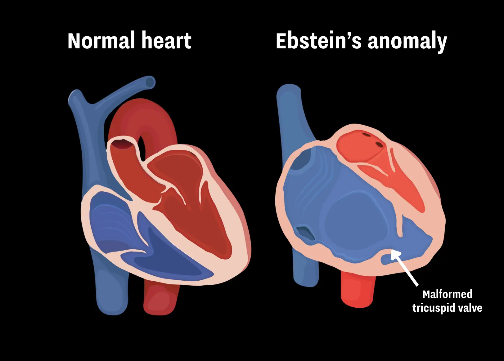 Ebstein's anomaly is a rare heart defect (Getty Stock Images/UNILAD)
