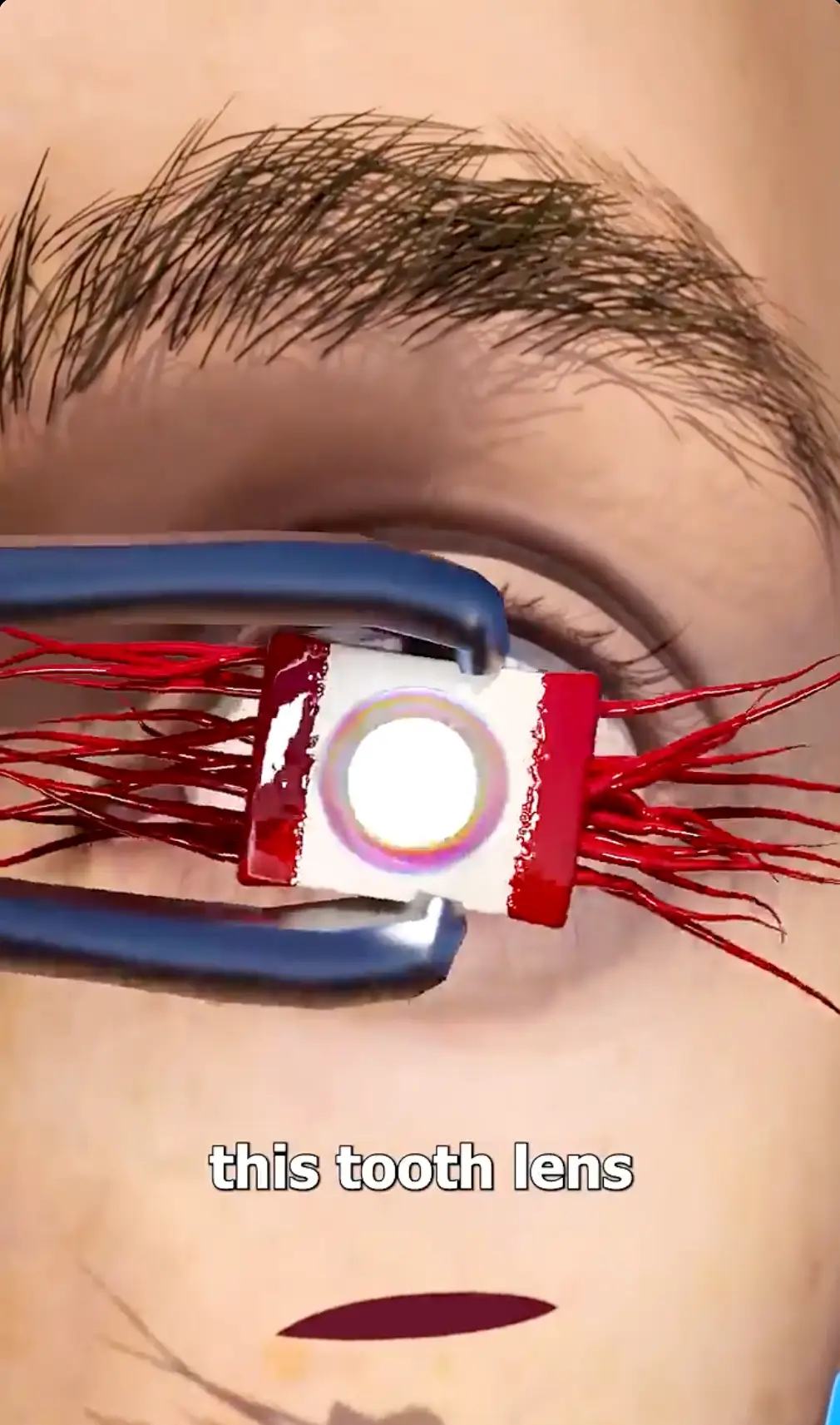 This is implanted into the eye. (Reddit / ChairmanMeowOfficial)