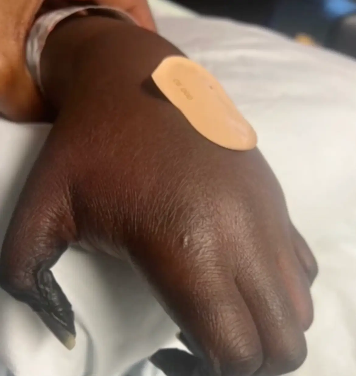 Deesh's finger tips turned black (BBC News)