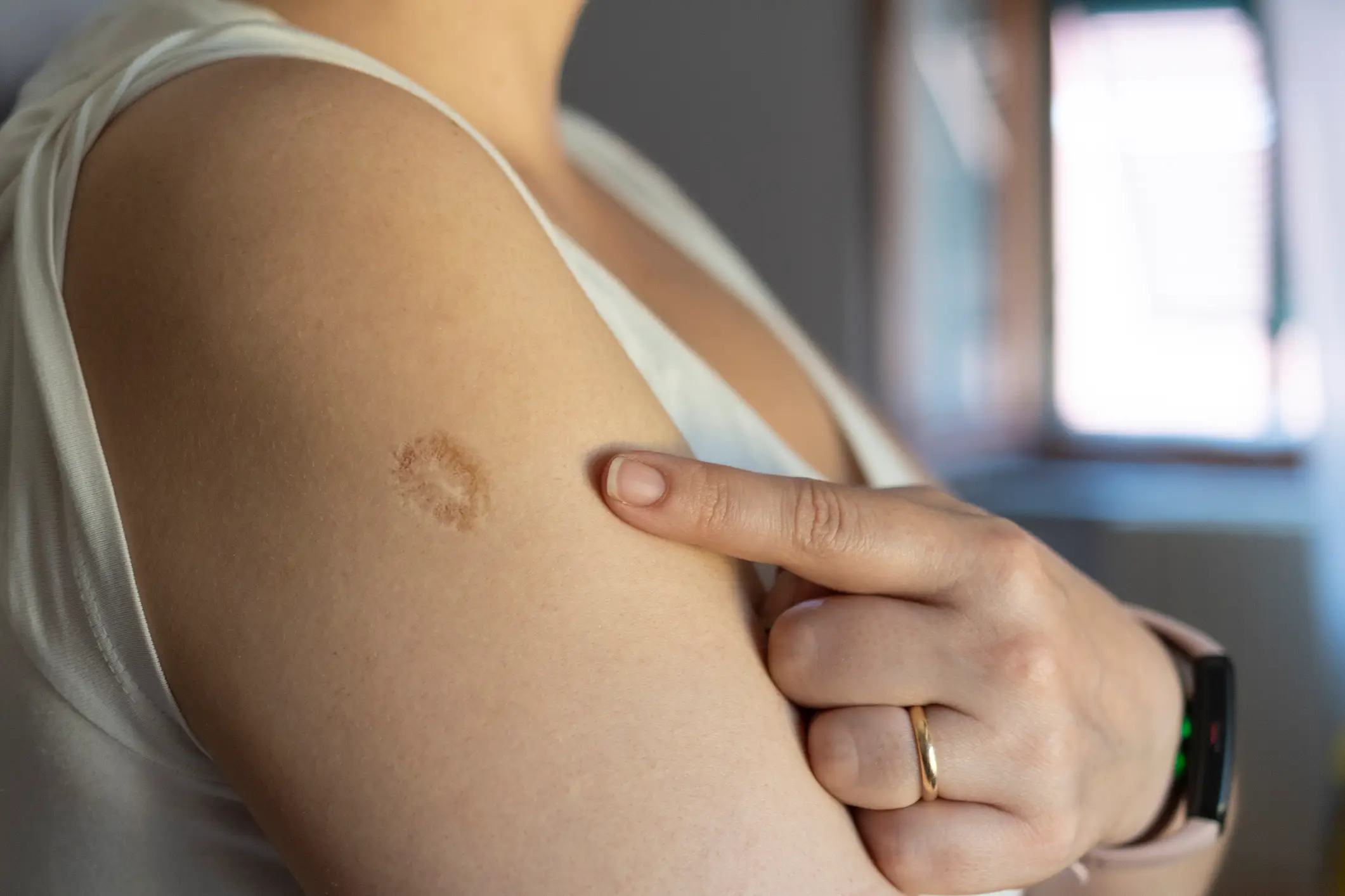 Smallpox scars are more likely to be found on the older generation (Getty Stock)