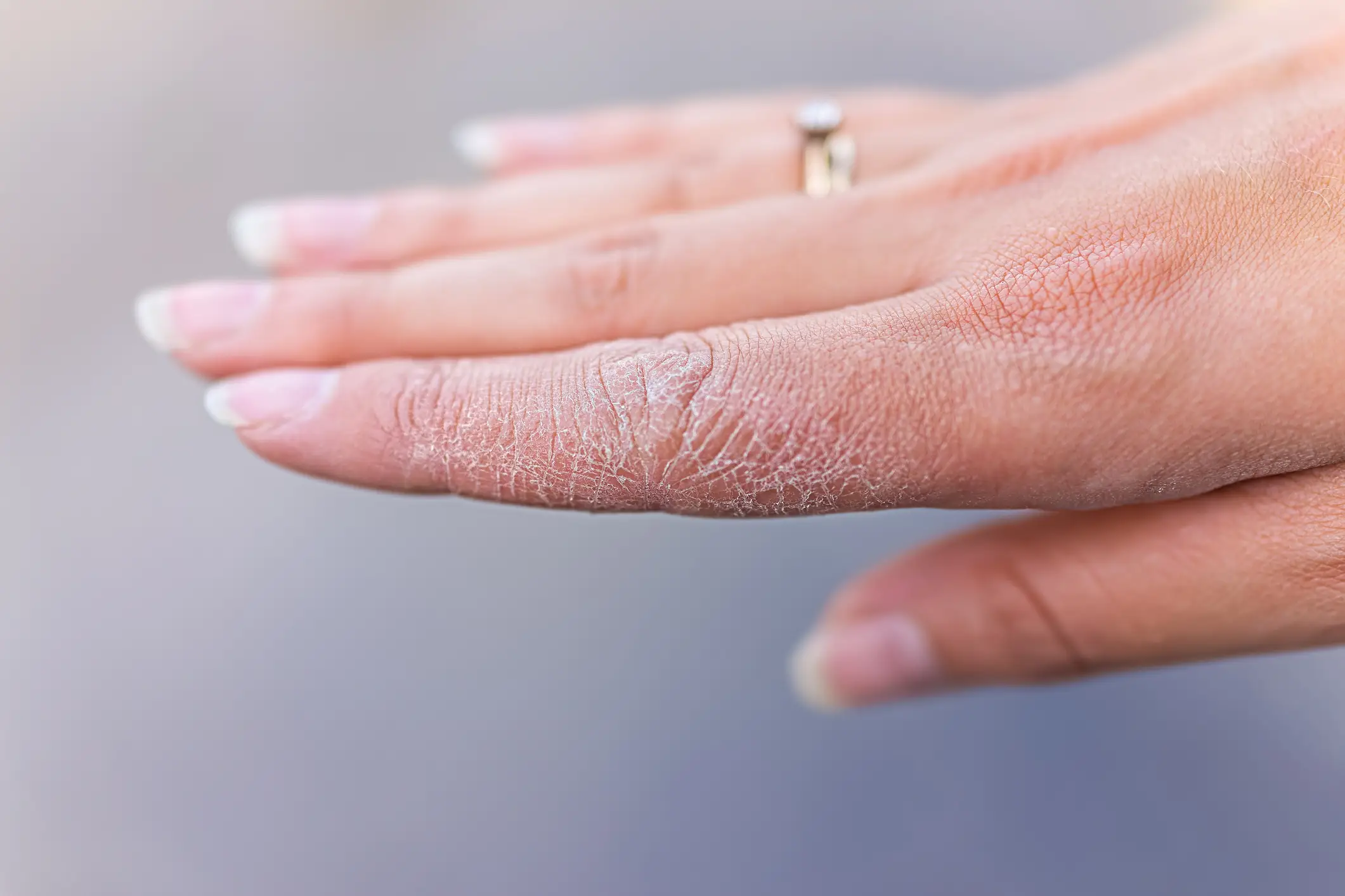 According to the National Eczema Society, “This condition can occur at any age but is usually seen in adults under 40, and is more common in women" (Getty stock image)