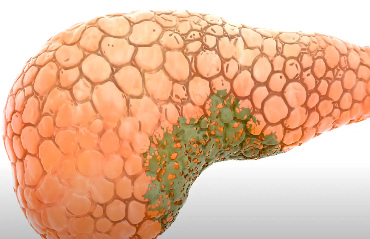 JS' pancreas started to digest itself.