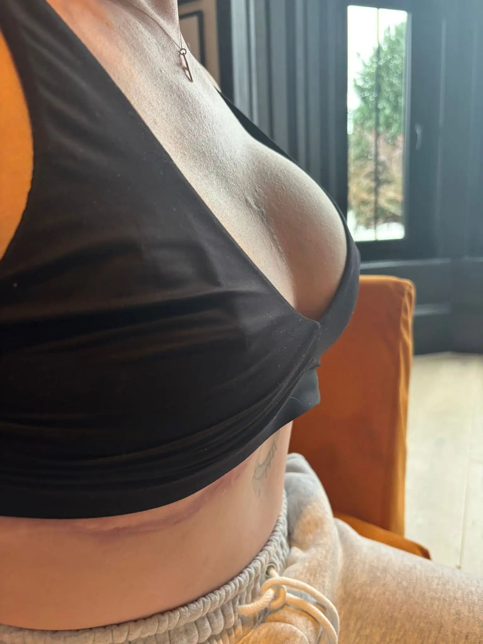 Lisa has been left with different sizes breasts as a result of the botched surgery (SWNS)