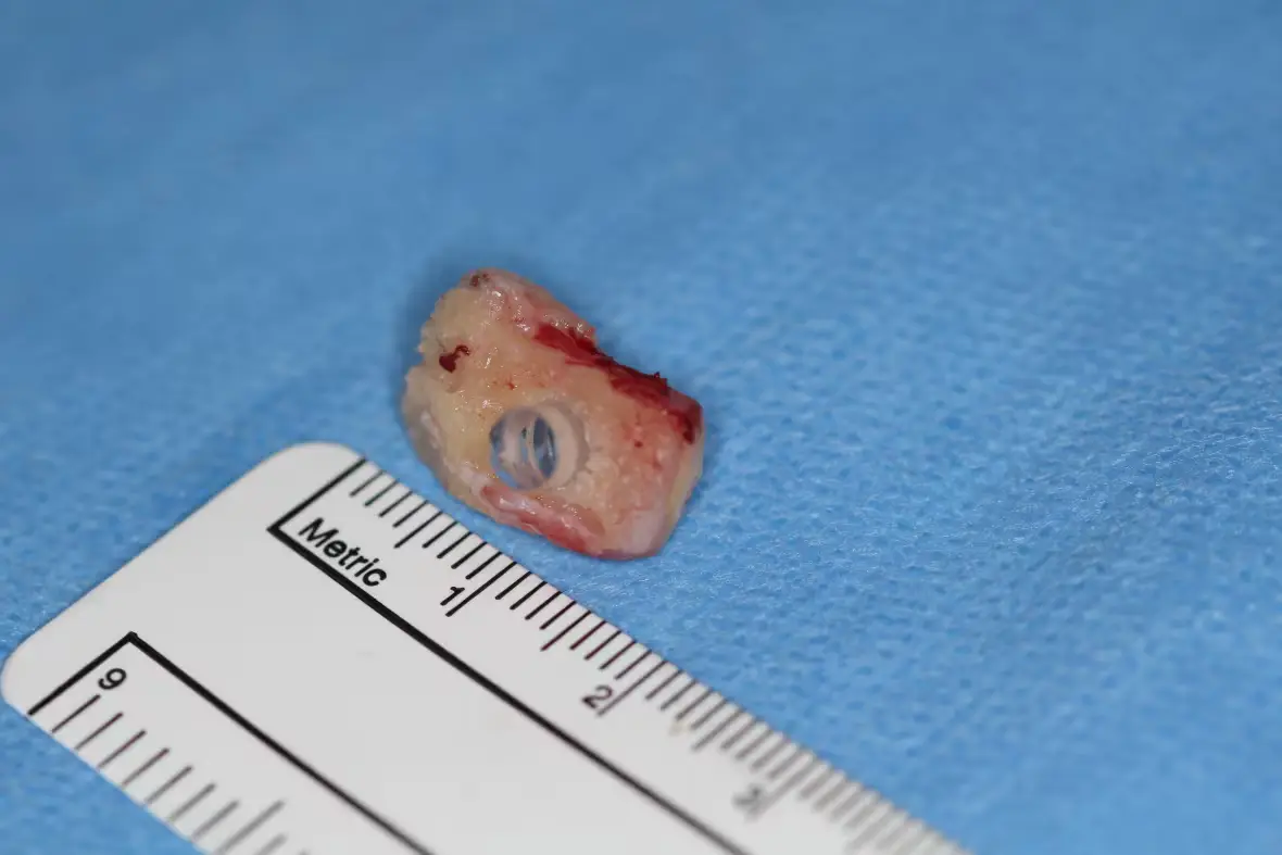 The tooth will be implanted into Chapman's eye (Facebook/St. Paul's Foundation/Providence Health Care)