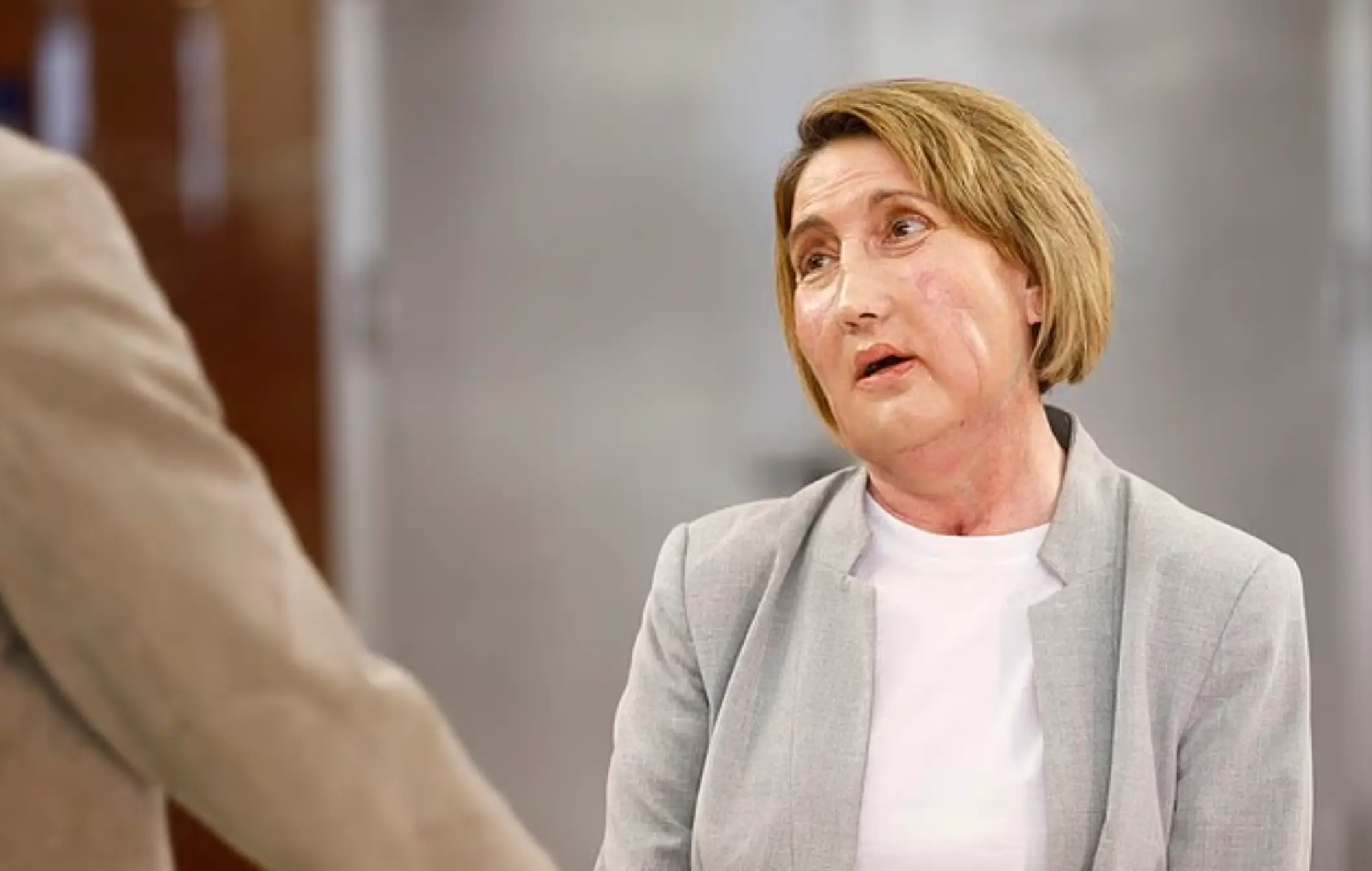 Around 100 healthcare professionals worked on transplanting Carme's new face for close to 24 hours (YouTube/Val d’Hebron)