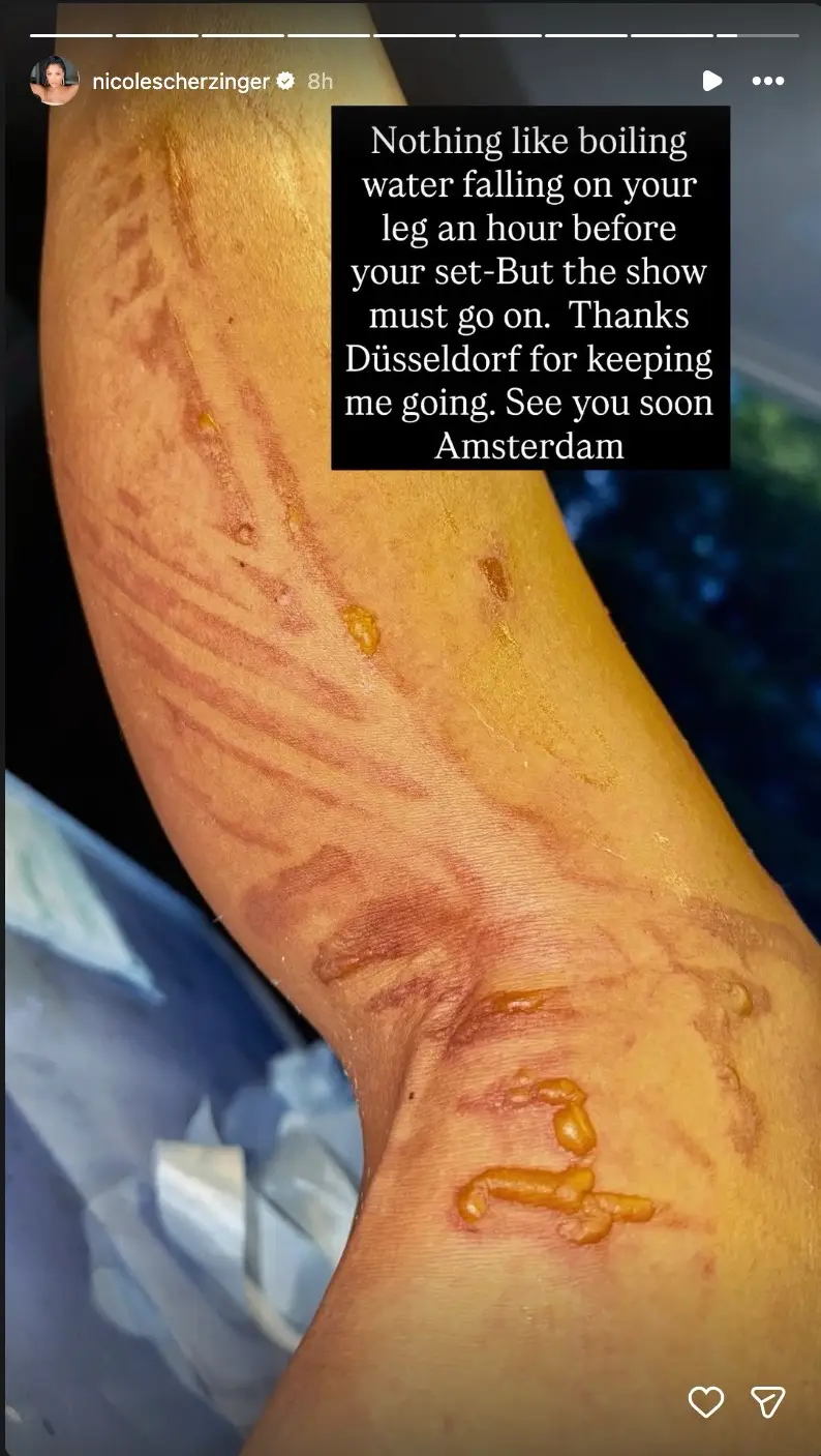 Nicole showed off the painful injury which occured just an hour before she was due on stage (Instagram/nicolescherzinger)
