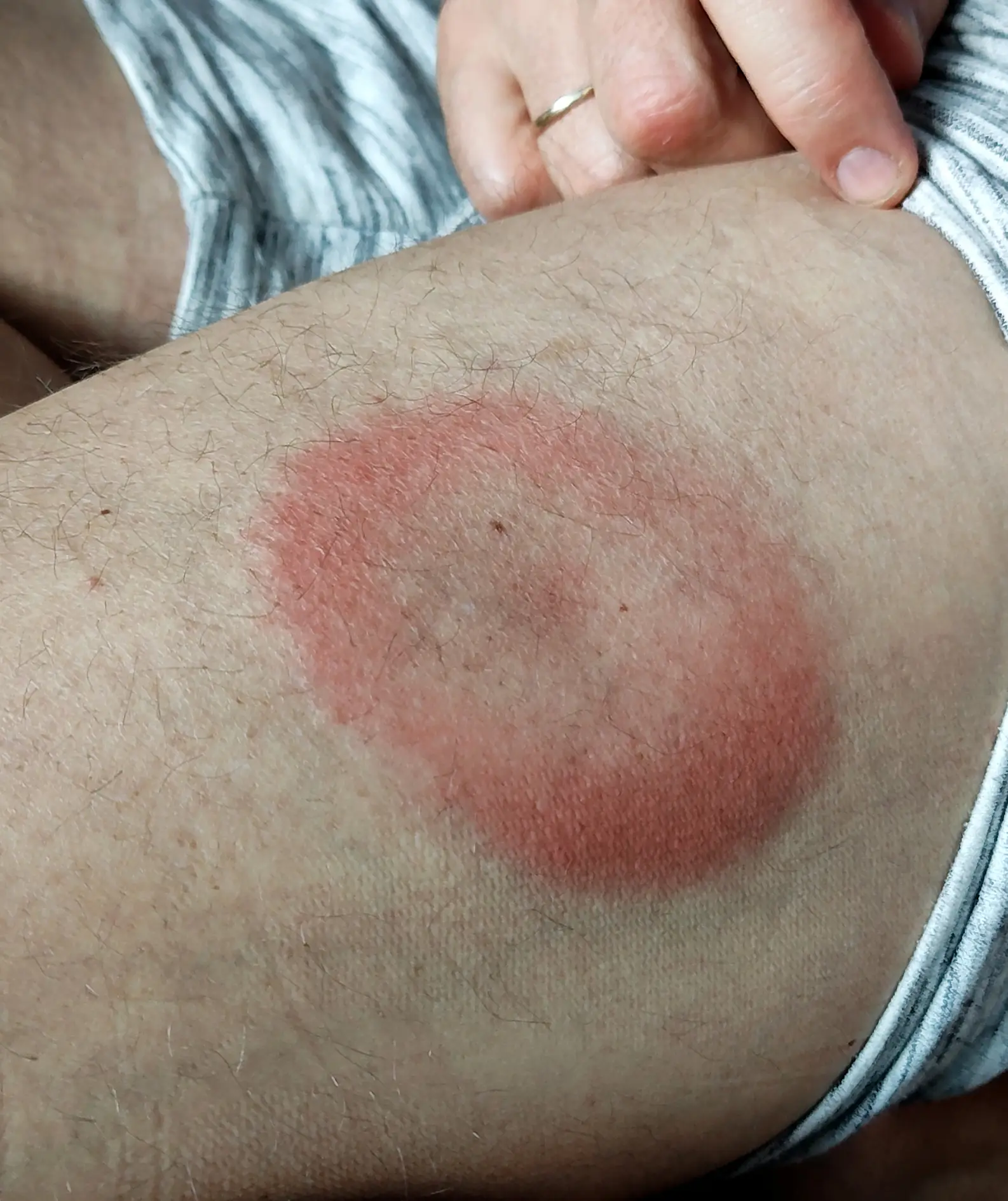 A common sign is a bull's-eye rash (Getty Images)