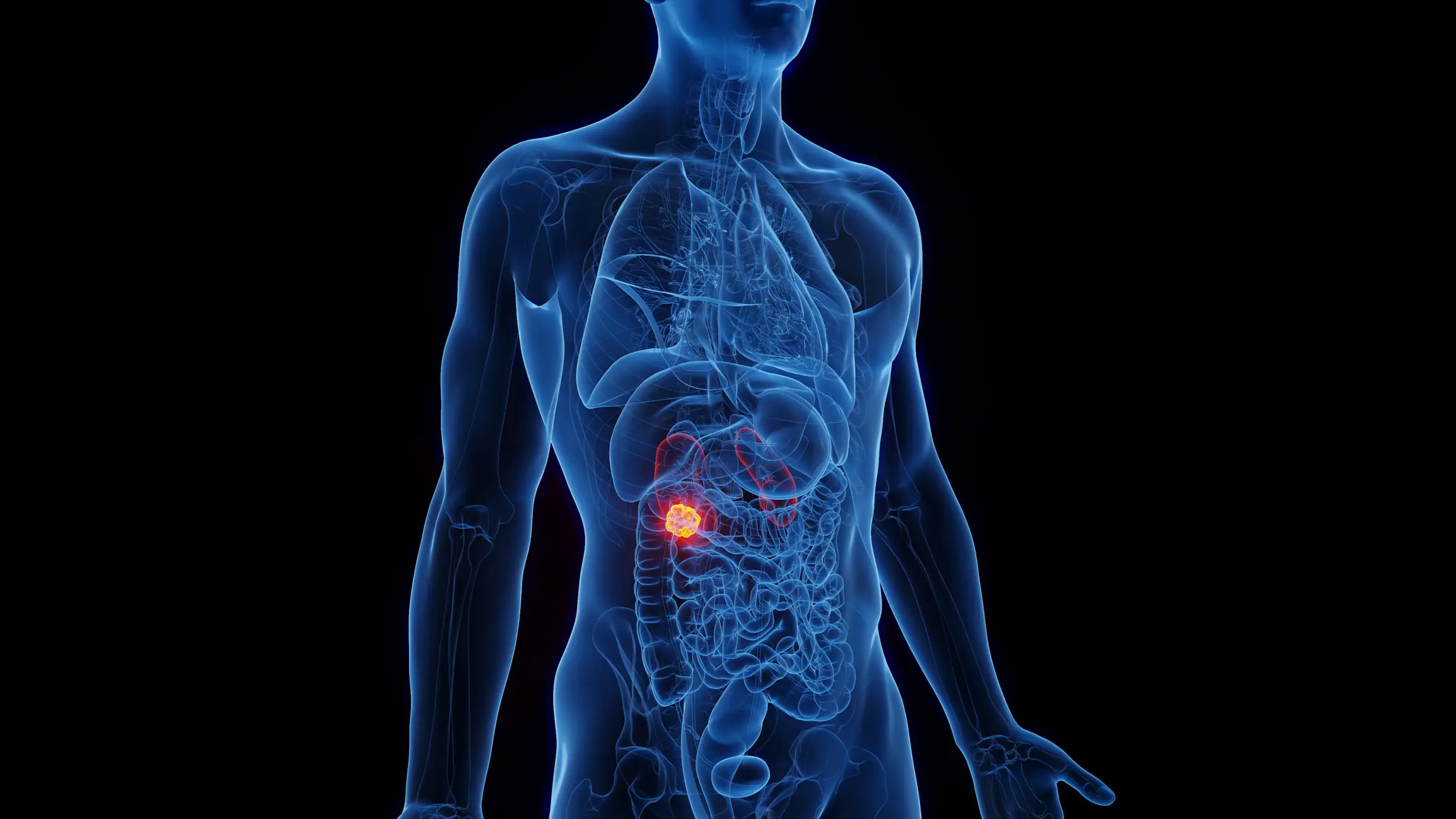 The biggest risk factors are smoking, obesity and hypertension (Getty Stock Photo)