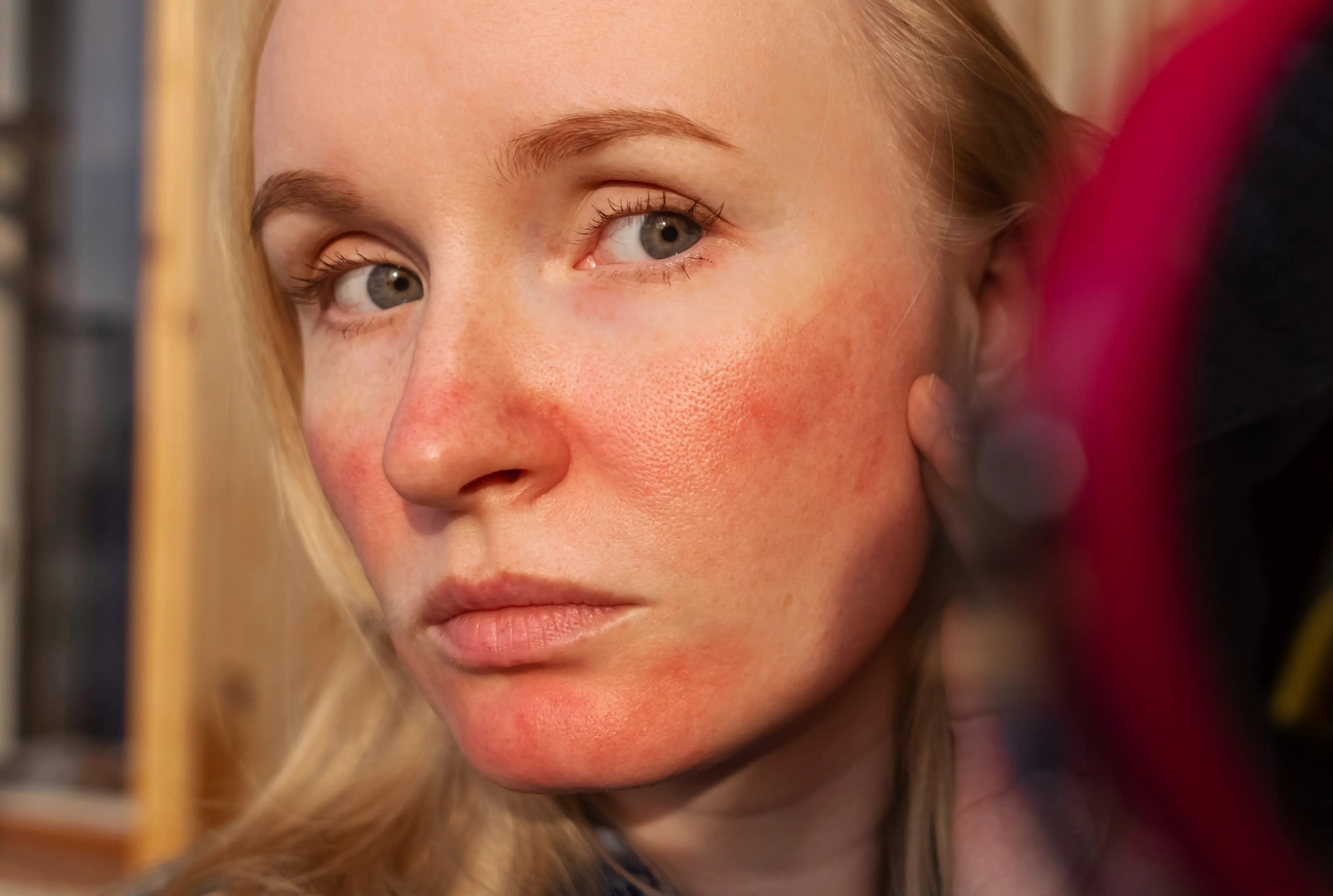 Some symptoms can be mistaken for rosacea (Getty Stock)
