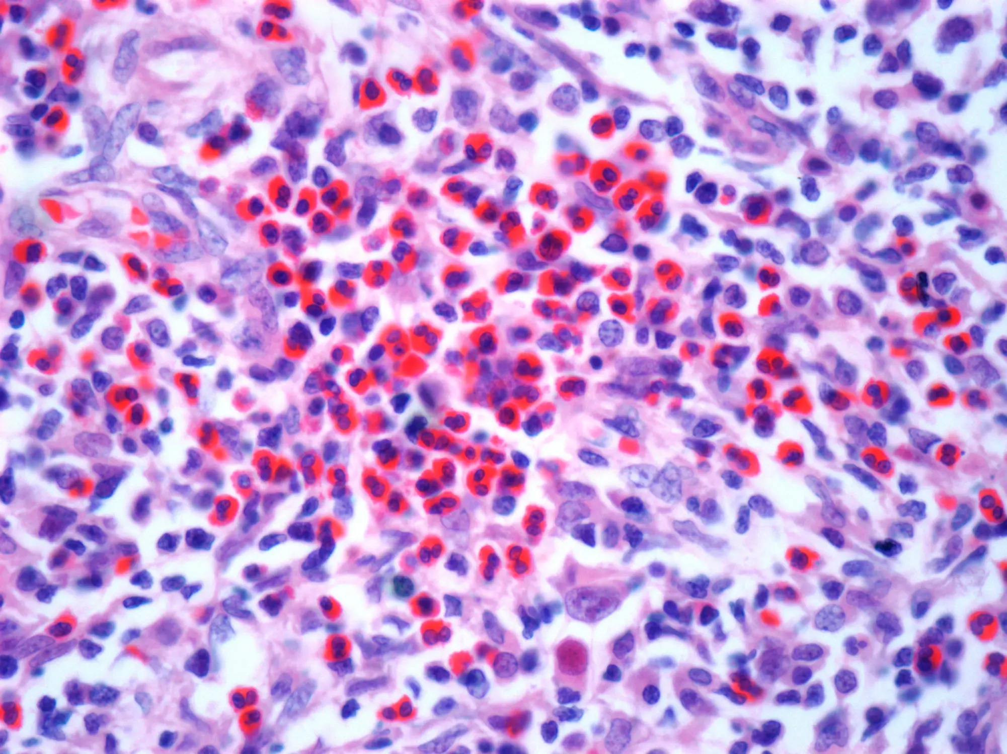 A light micrograph of a section through a lymph node affected by Hodgkin's lymphoma (Getty Images/Science Photo Library - STEVE GSCHMEISSNER)