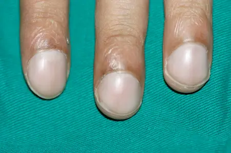 What nail clubbing can look like (Dr Murlidhar Rajagopalan)