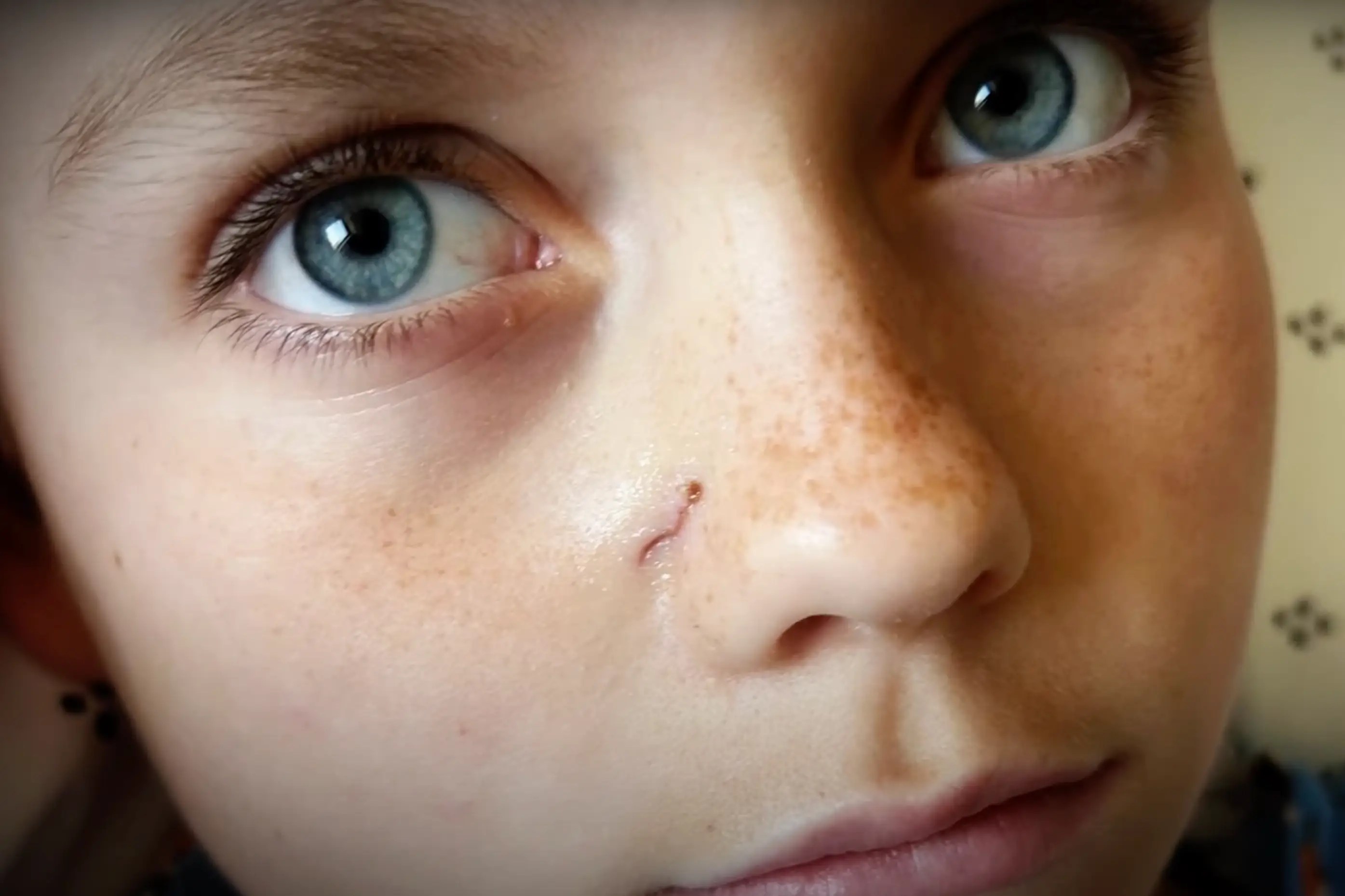 The wound left behind after the arrow pierced through Gus Deterding's brain (KARE 11)