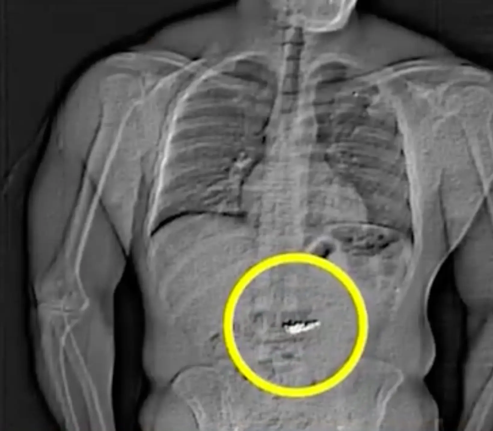 An X-ray of the jewlery found inside Gilder (Fox 35 Orlando)