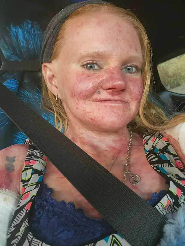 Rachel has something called Epidermolysis Bullosa (GoFundMe)