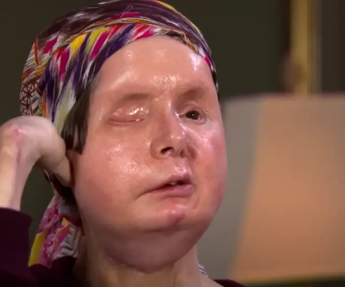 Nash underwent hours of surgery to replace her face (60 Minutes Australia)
