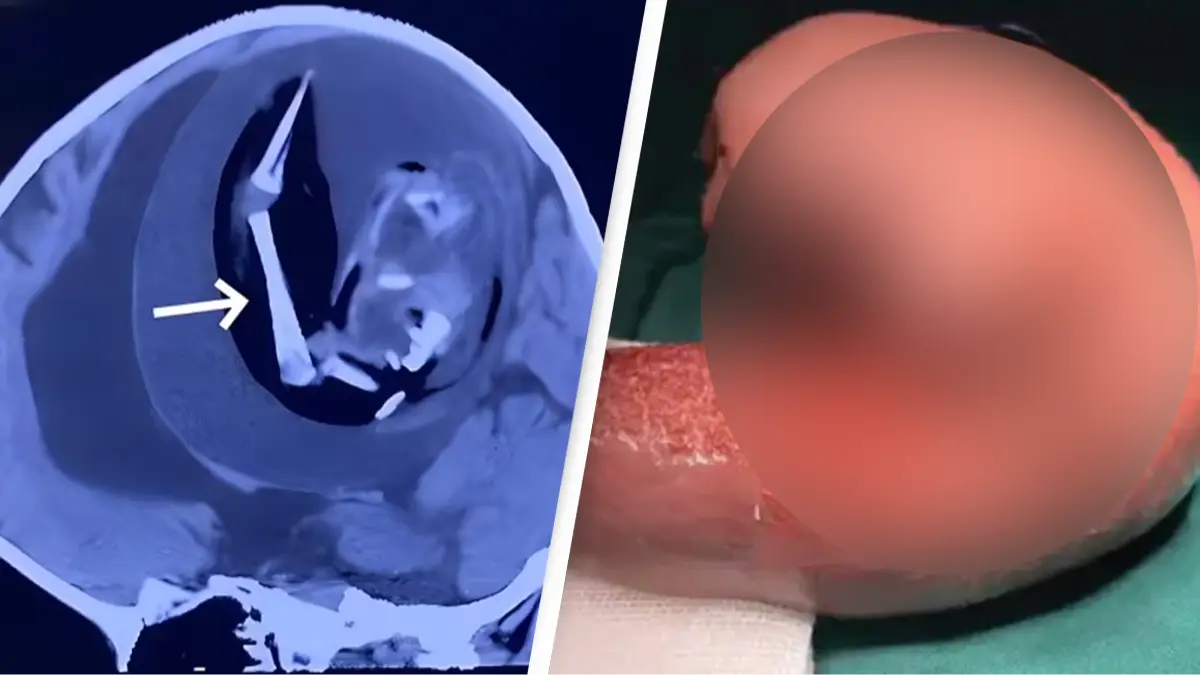 Neurology Journals/ Zongze Li et al 