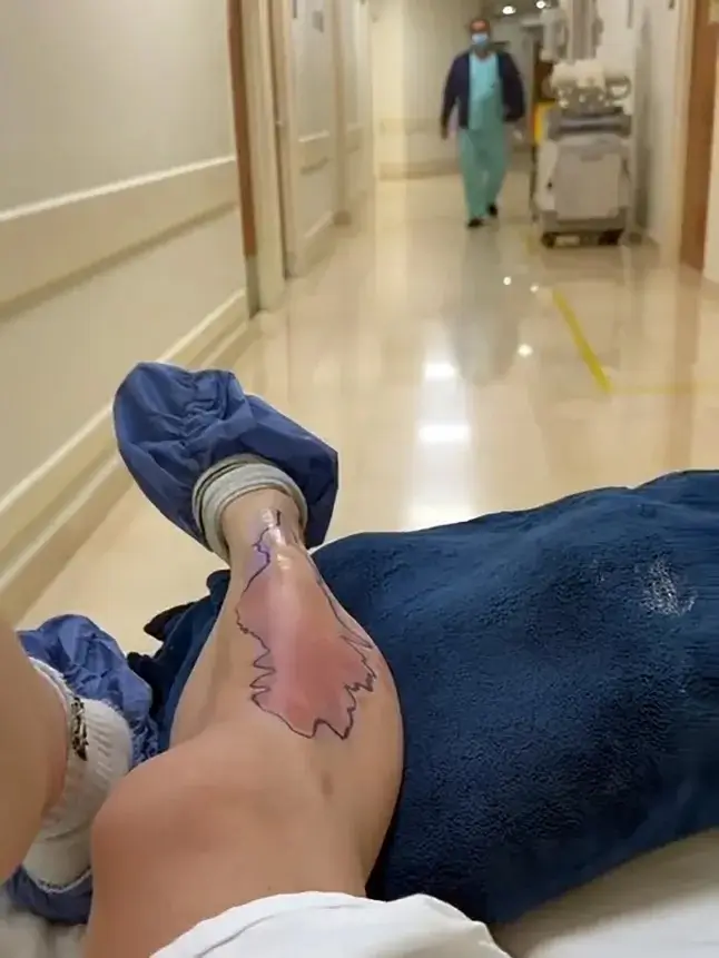 Unfortunately, Momsen suffered a severe reaction to the venom (@taylormomsen/instagram)