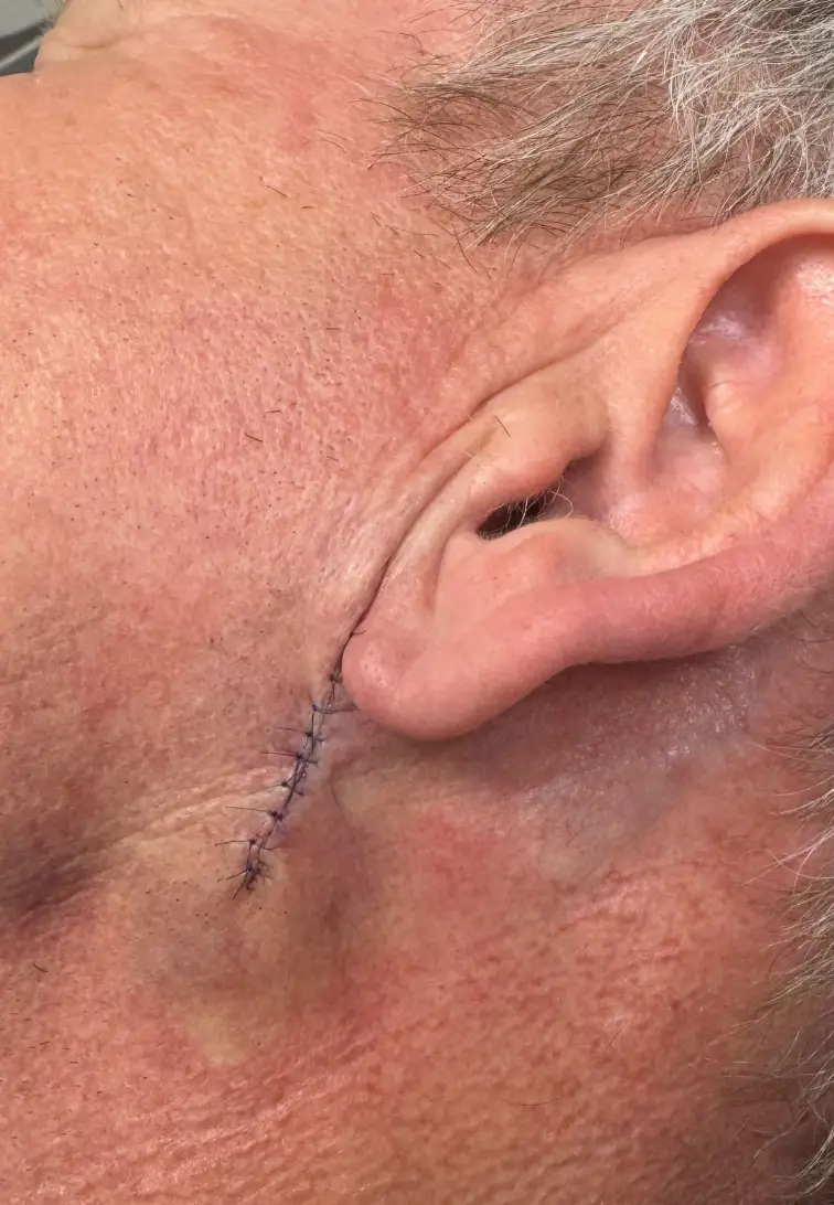 Gordon Ramsay shared a photo of the site where he had the cancer removed (gordongram/Instagram)