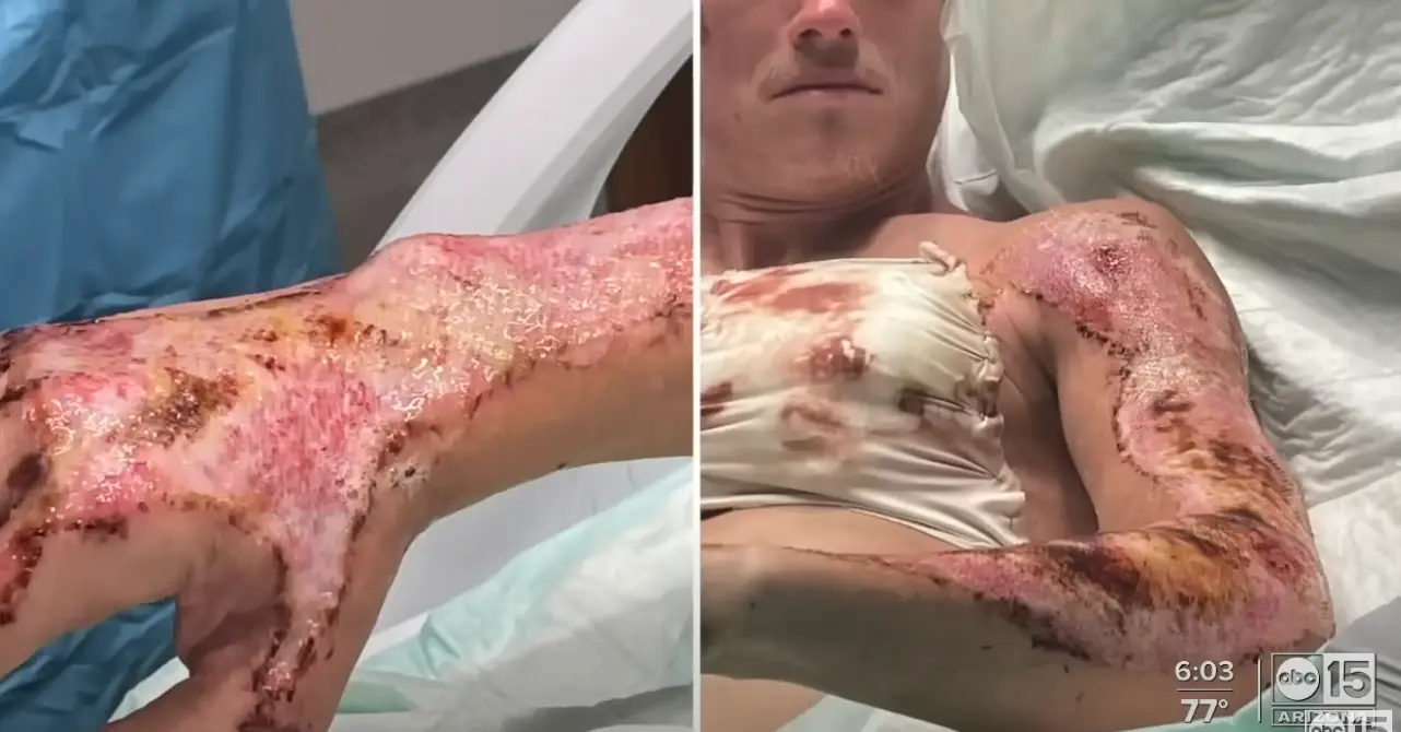 Michael Kenyon's arms, hands and legs were burned when he was pinned to the ground (ABC15)