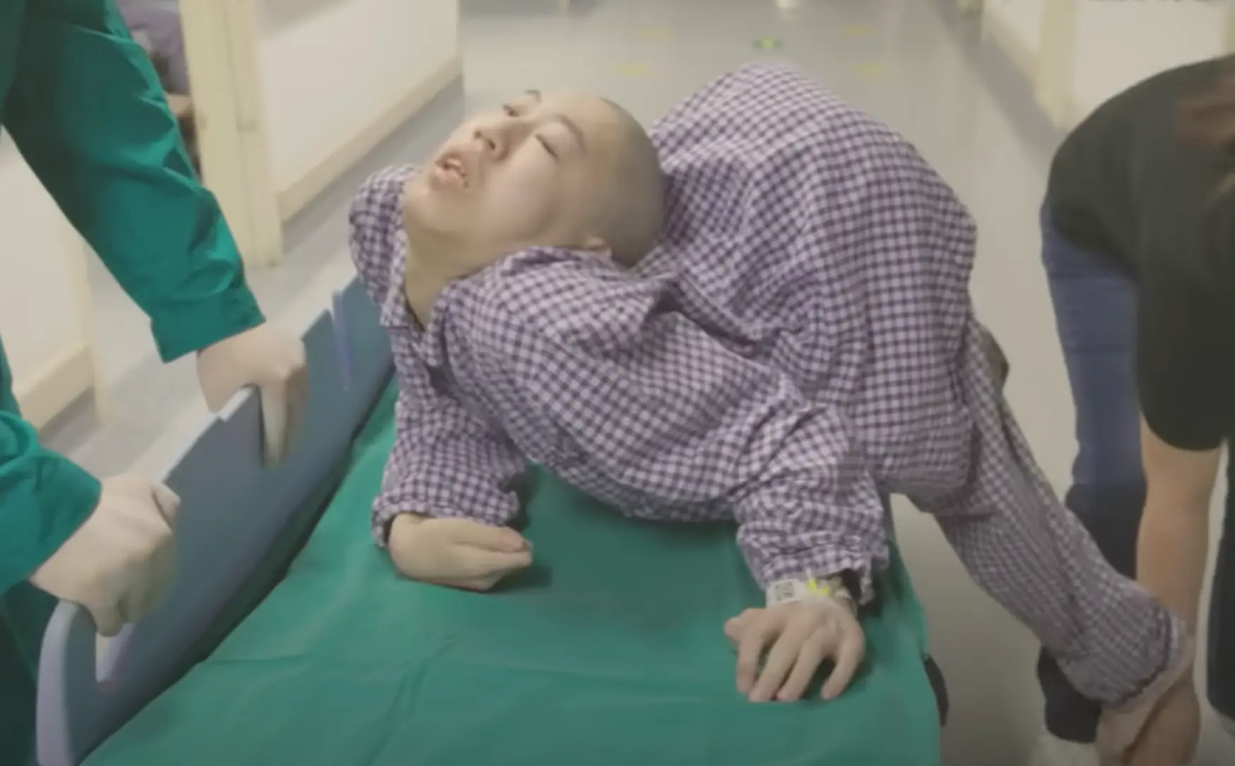Jiang Yanchen, known as the 'folded boy,' underwent four surgeries to correct the 180-degree deformity in his spine (YouTube/South China Morning Post)