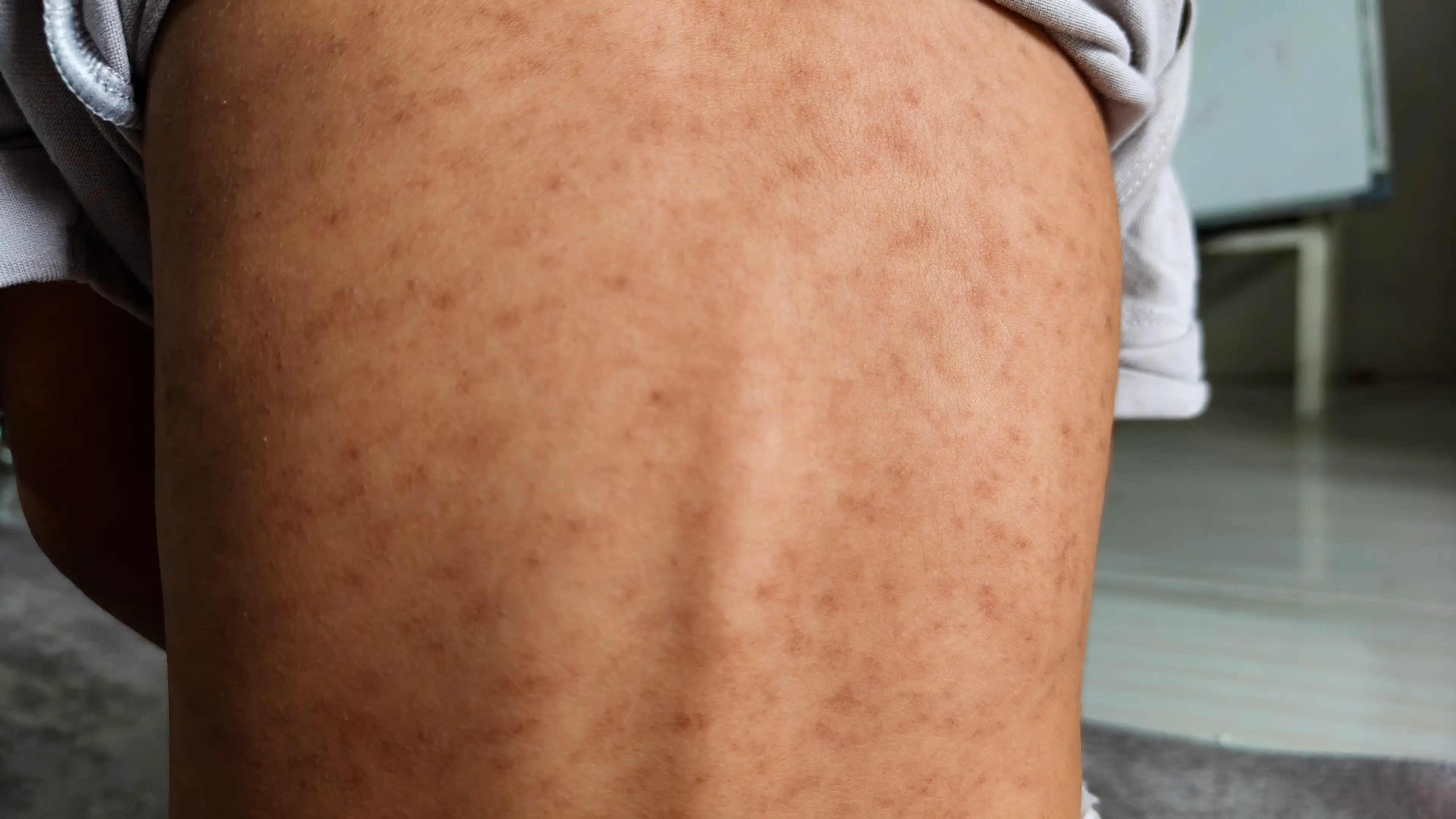 A rash is a big symptom of measles (Fajrul Islam/Getty)