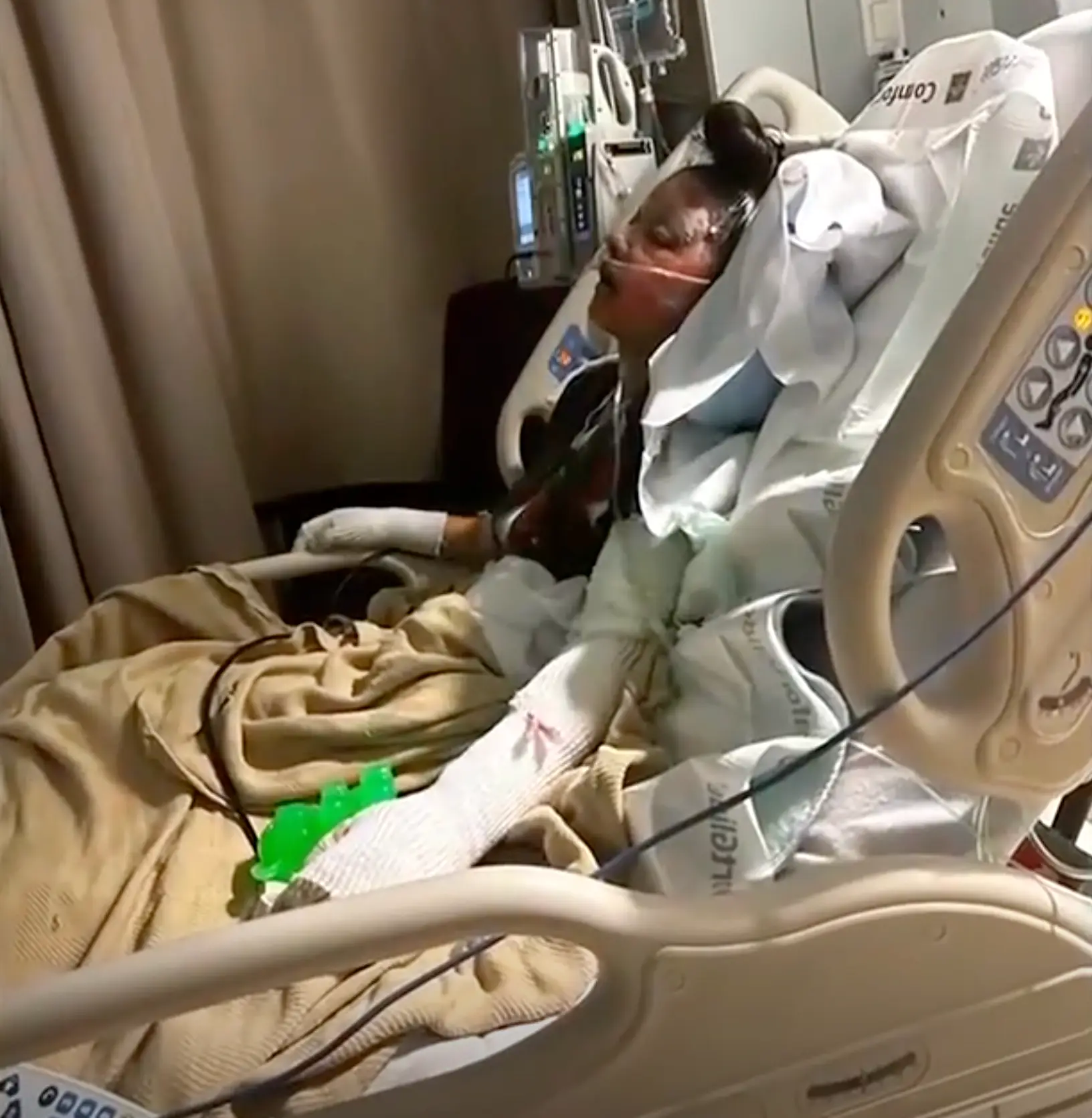 Mia is currently receiving treatment for second-degree burns to her face, arms, hands and legs (Alaska News Source)