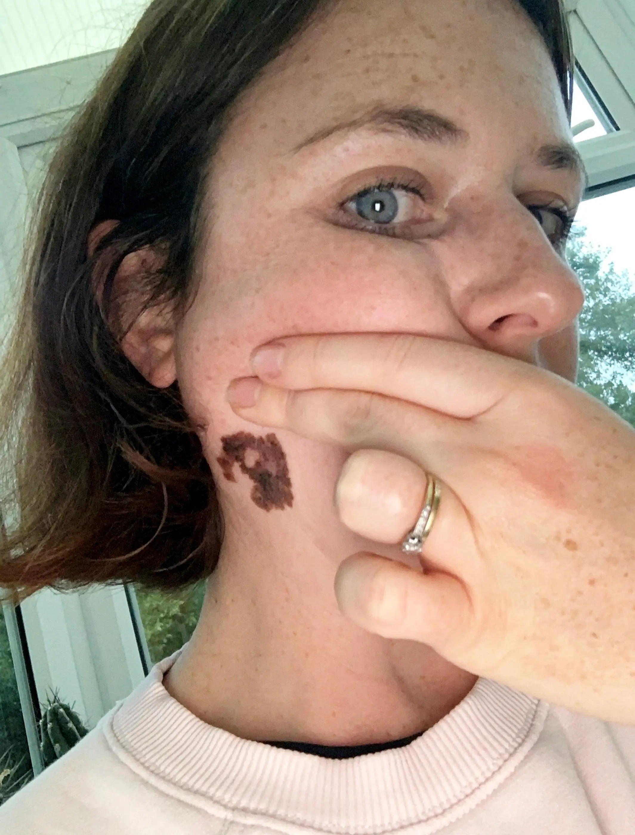 Sarah wants to warn other people to be careful when they are out in the sun (SWNS)