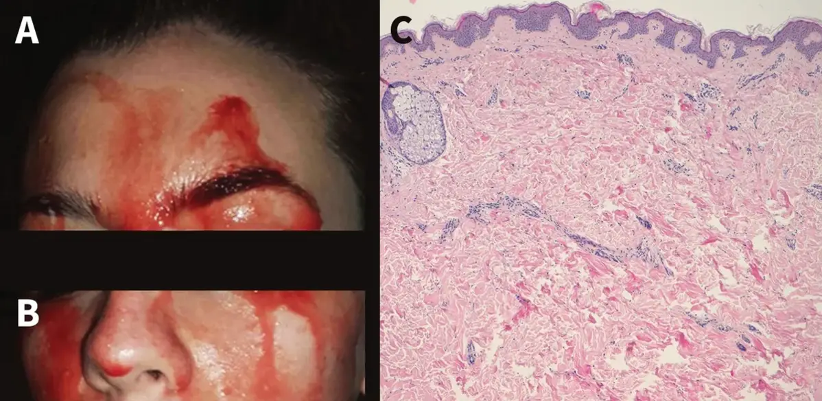 On the left, an image of the woman's face during a bleeding episode. On the right, an image of the woman's skin under a microscope, which showed normal tissue. (CMAJ)