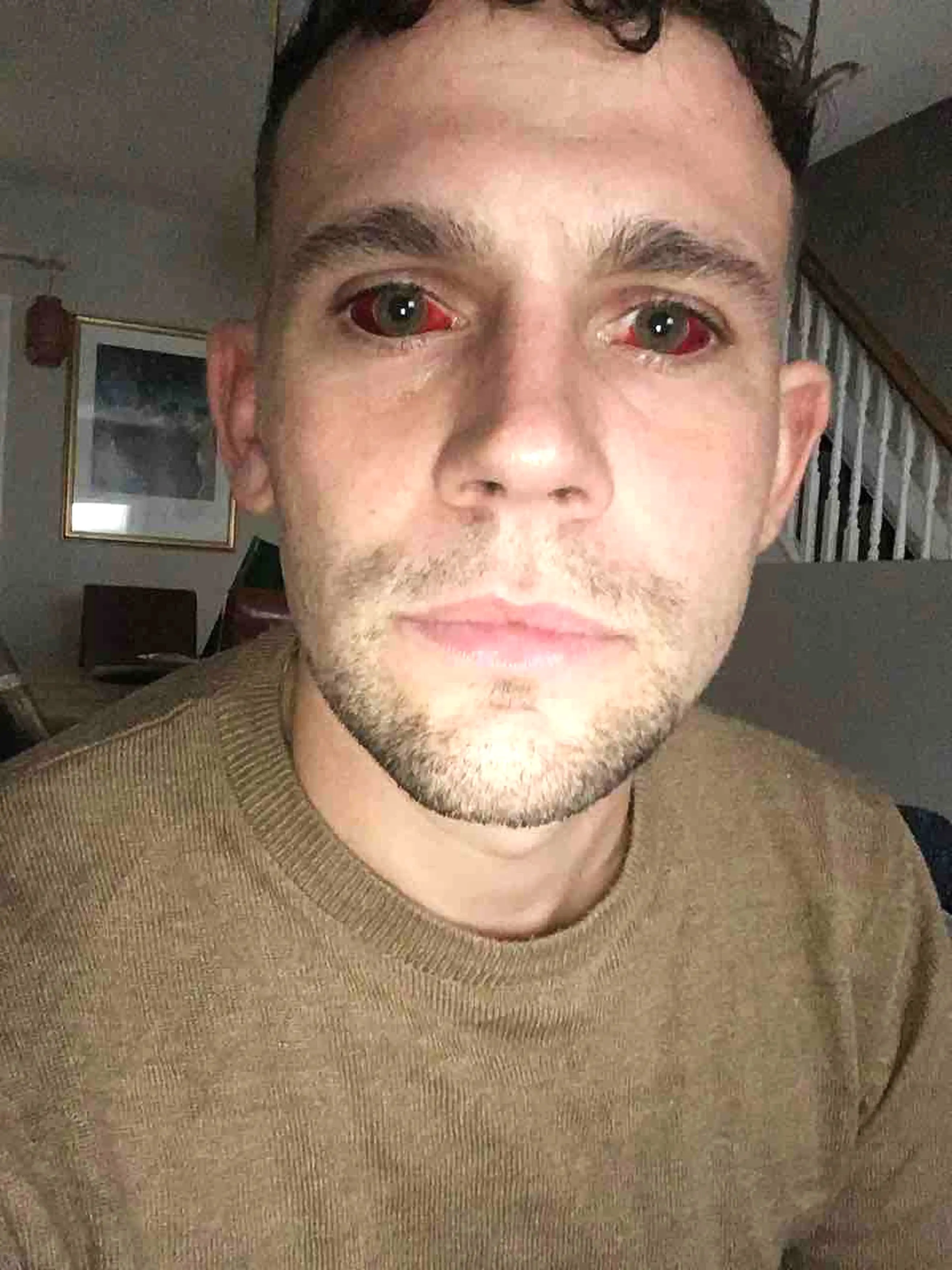 Dave was left with extremely bloodshot eyes (Kennedy News)